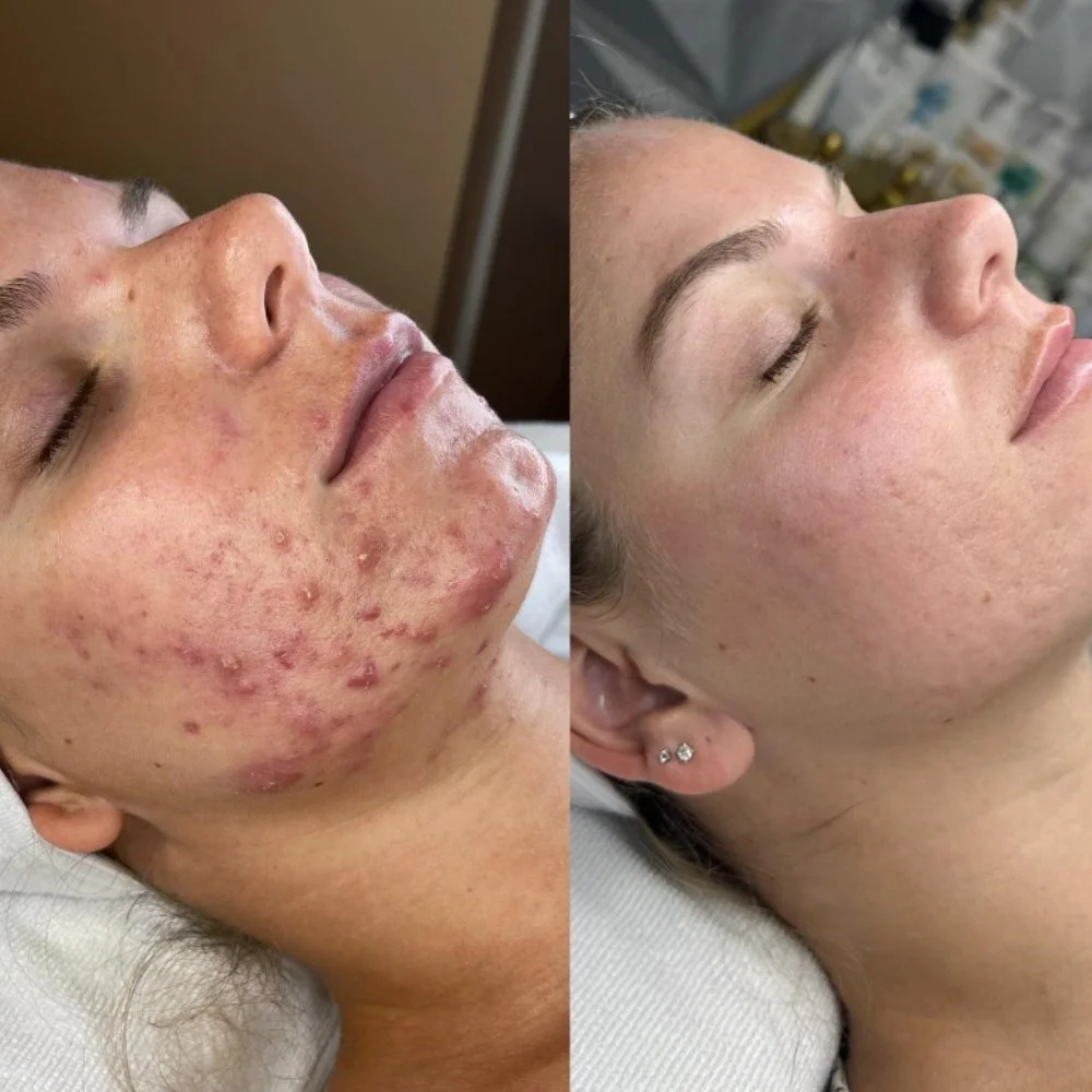 microneedling