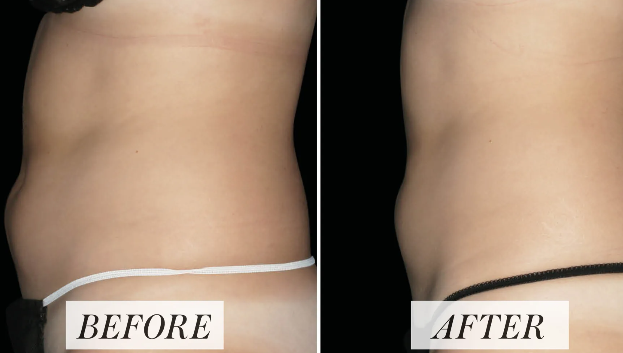 body contouring procedure