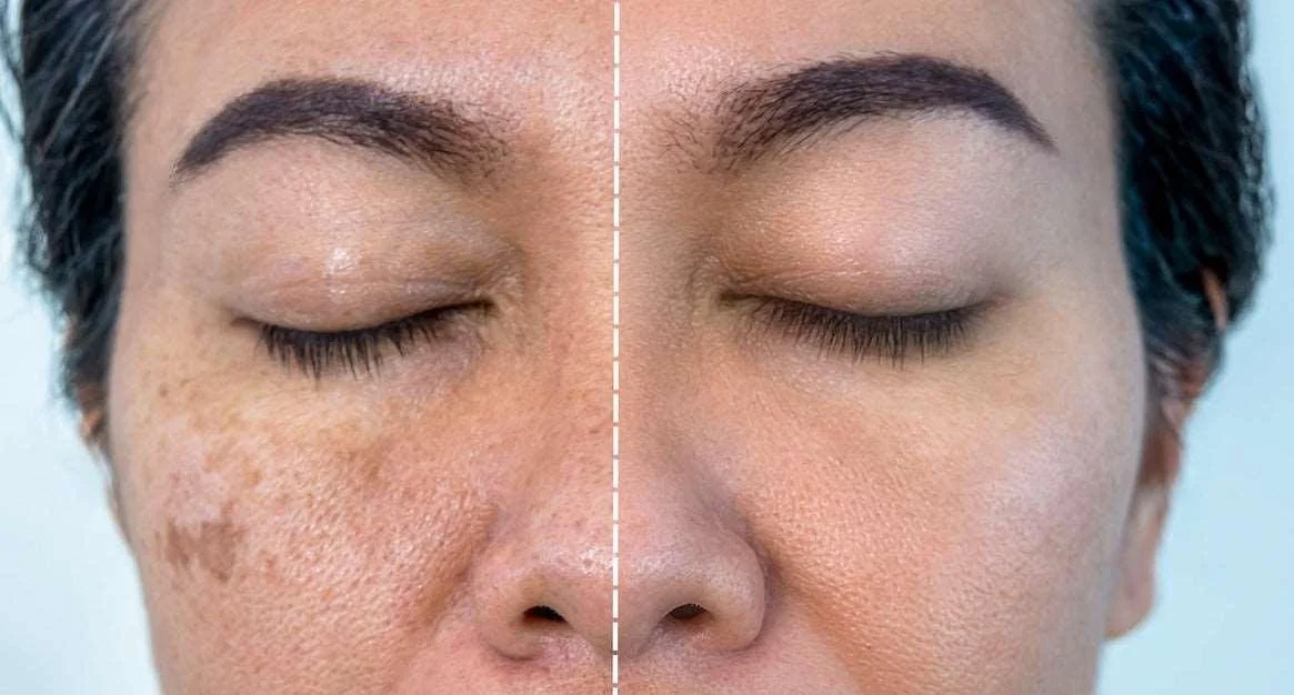before and after mesotherapy