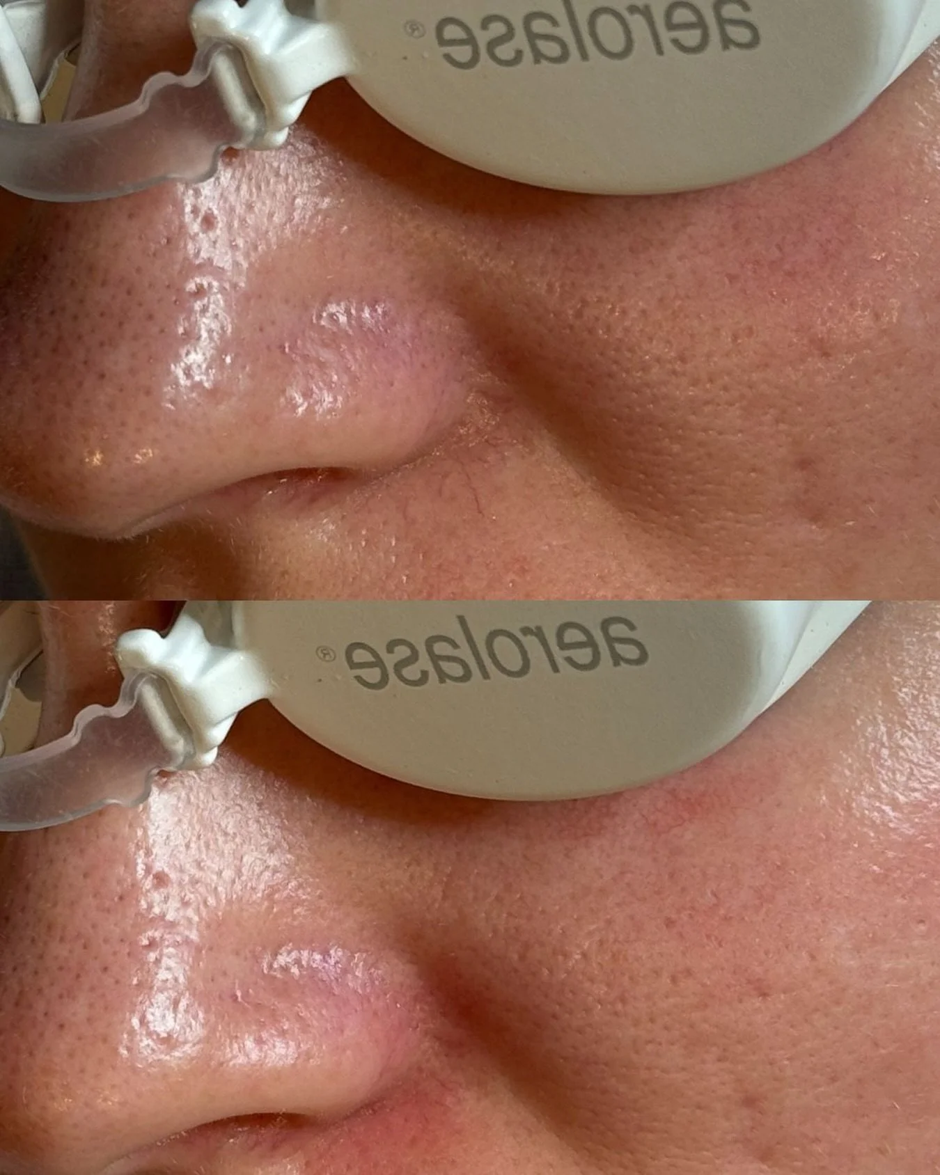 BEFORE &amp; AFTER | Visible capillaries in this area are very common and something we treat regularly in clinic. Using the Aerolase Neo Elite, targeted energy is delivered to gently heat and coagulate unwanted vessels (The photo on the bottom was ta