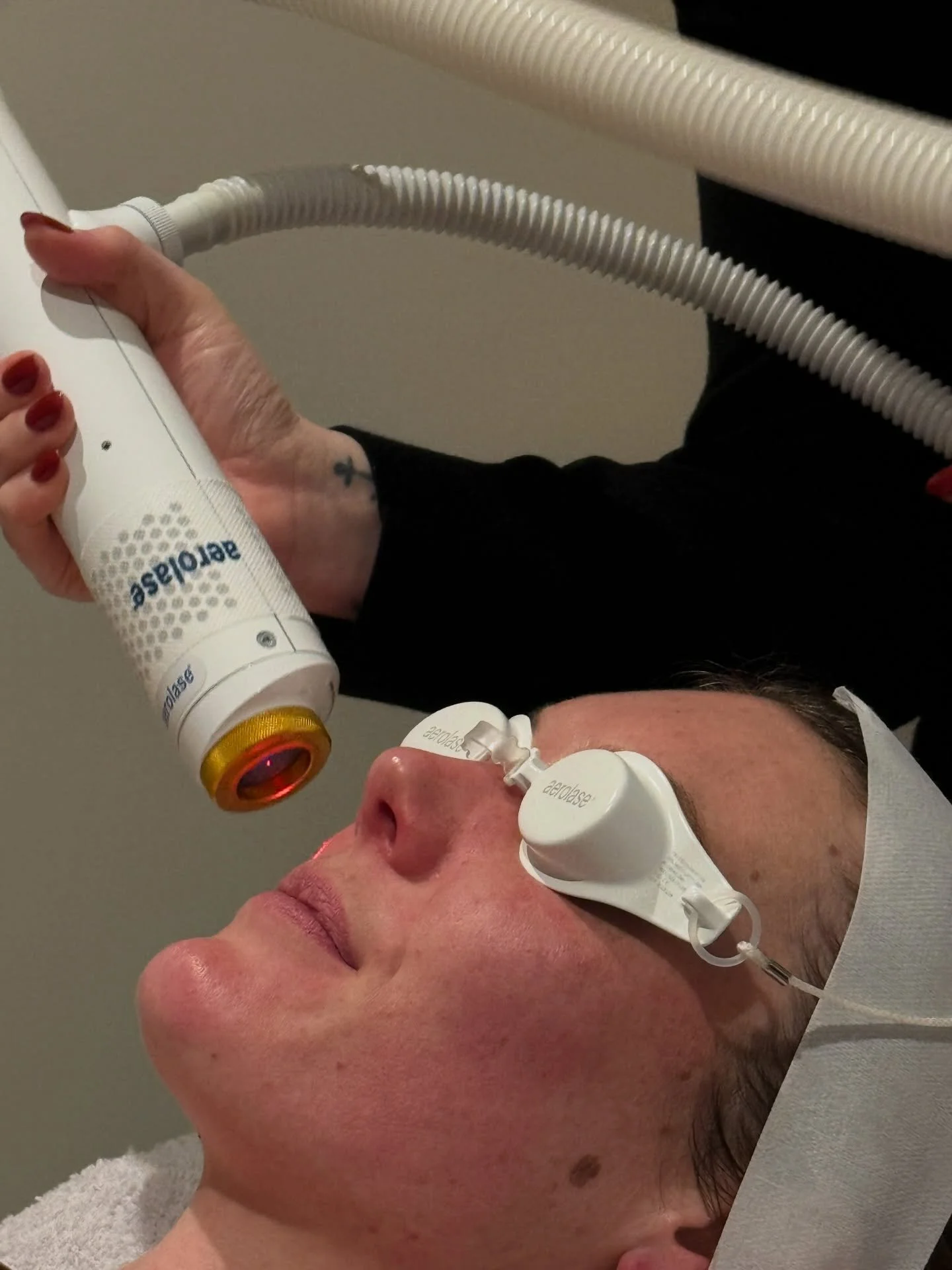 THE PERFECT PAIR | Introducing a new series at VERSA: The Perfect Pair - where we highlight a treatment and the homecare that best supports it. To kick things off: our laser treatment for redness paired with Liposome Concentrate Plus (LCP) by dermavi