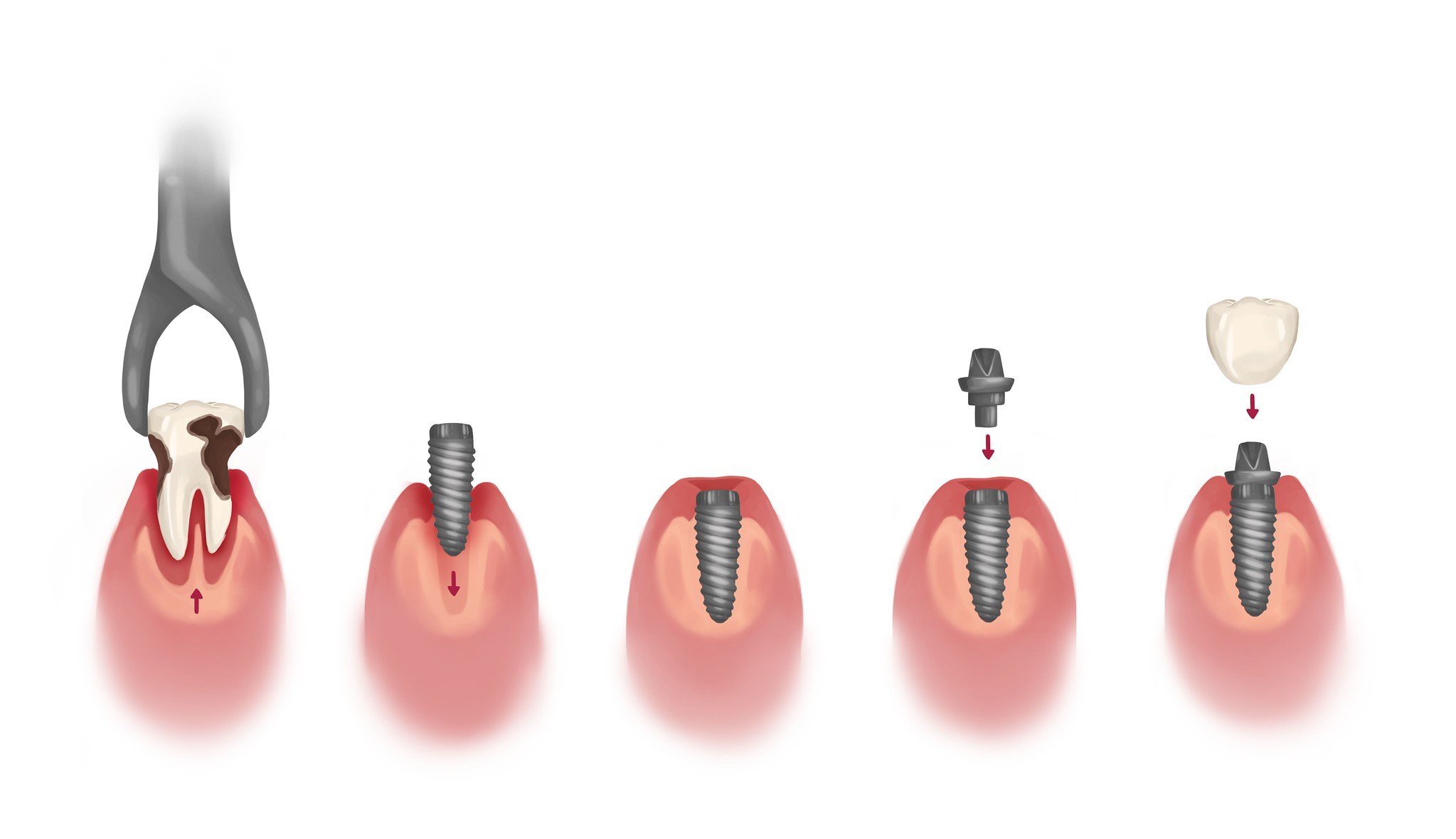 How Dental Implants Work, From Consultation to Completion