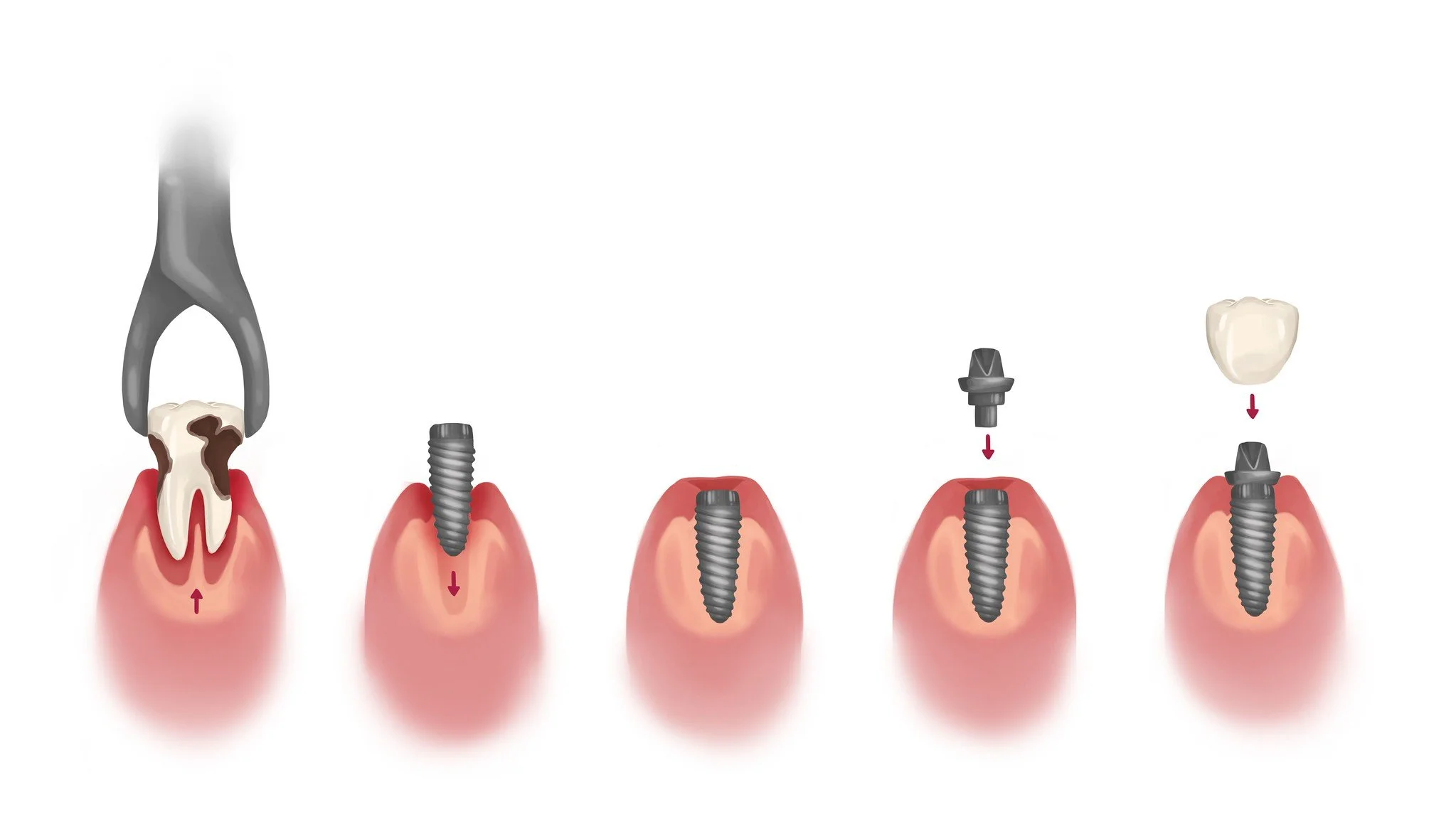 Illustration showing tooth extraction, dental implant placement, healing, abutment attachment, and final crown placement.