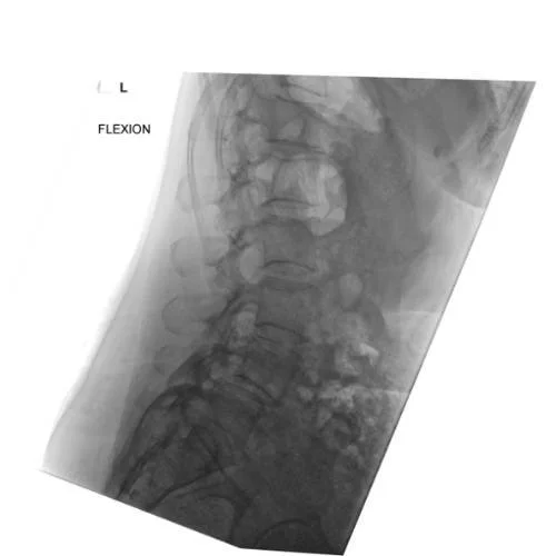 X-ray of Bertolotti Syndrome