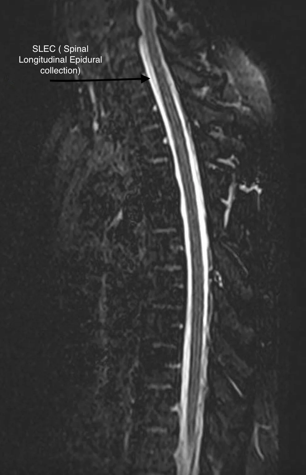 Sagittal MRI showing the spinal longitudinal epidural collection (SLEC) that helped diagnose Monica Durden's spinal CSF leak.