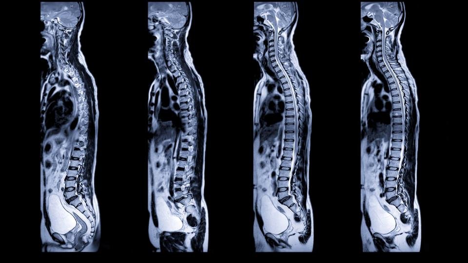 Series of side-view MRI scans used to assess spinal alignment, nerve compression and the need for treatment.