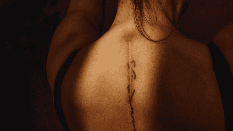 Photograph of Monica Durden's upper back showing the healed surgical scar following spinal CSF leak repair.