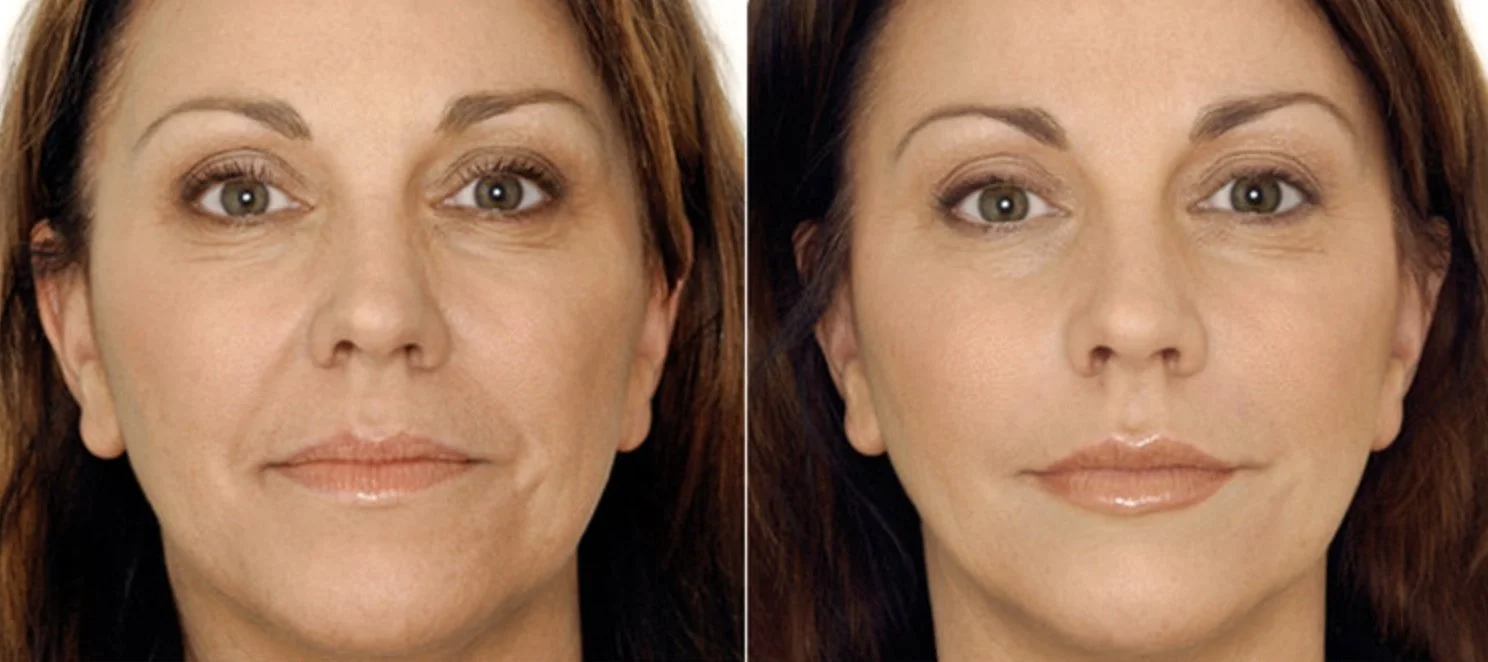 Vampire Facial before + after