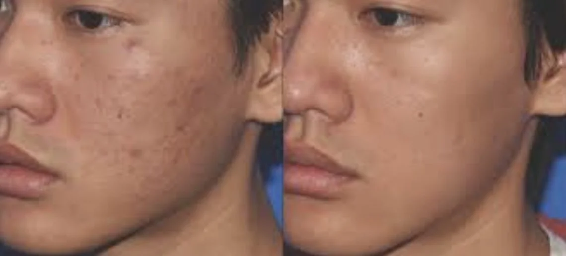 Vampire Facial before + after
