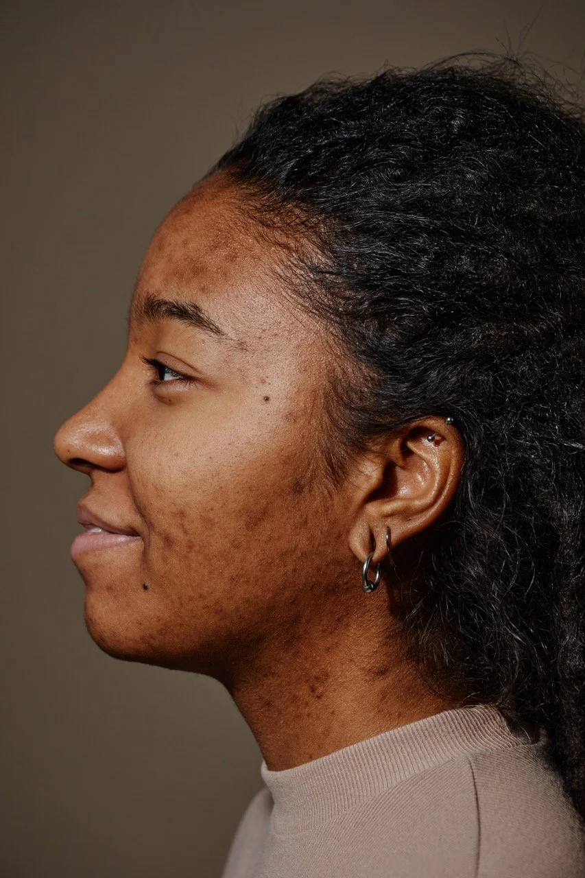 Hyperpigmentation and Dark Spots — SLK Beauty Lab