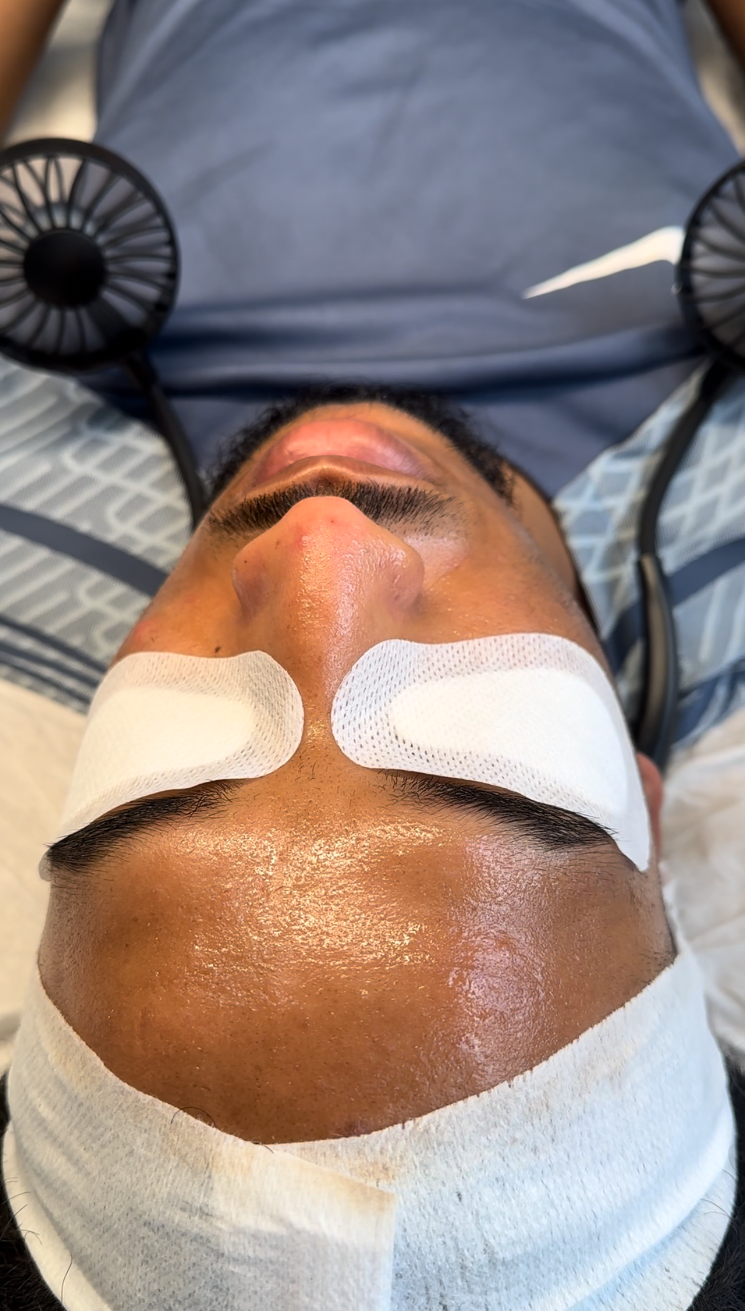 chemical peel (2).png