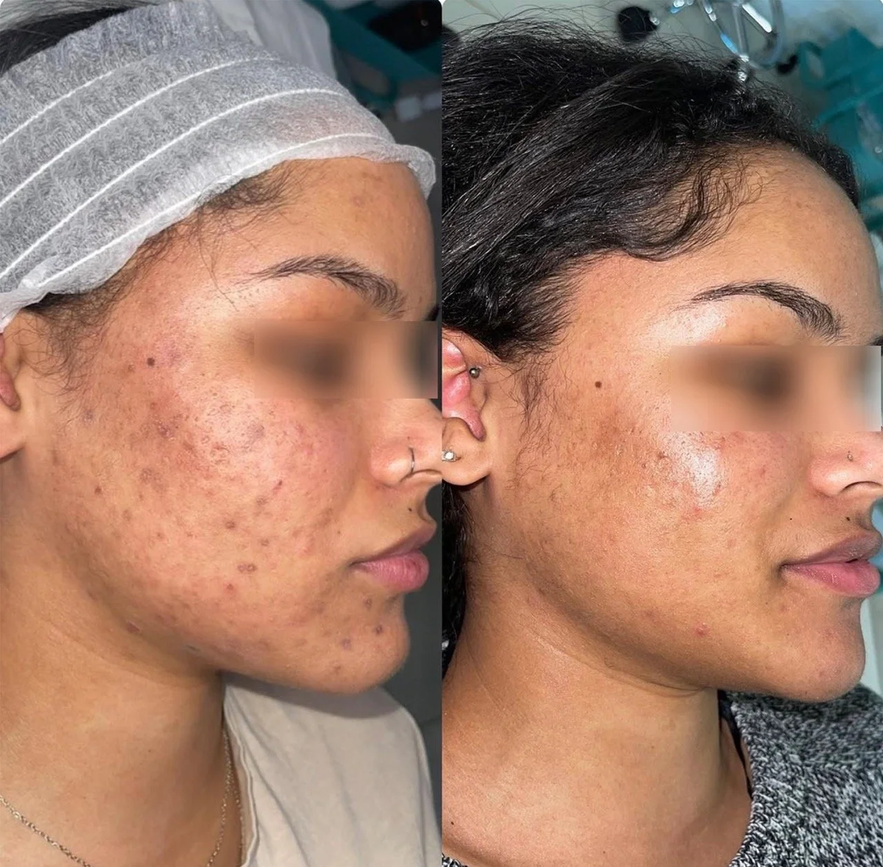 organo peel results 4 (2) Large.jpeg