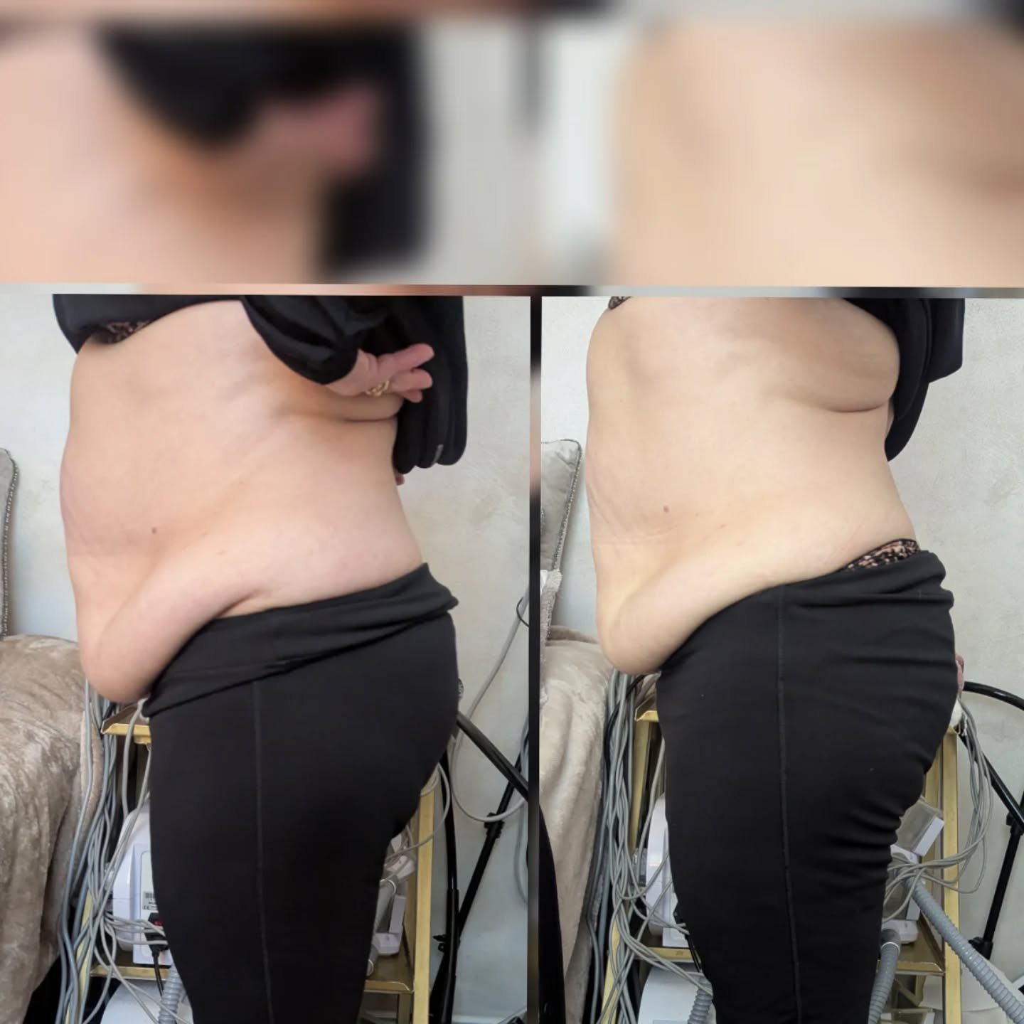 Fat freeze results on lower tummy overhang just one week post treatment, and today she's back and had just one session today of ultrasound cavitation all over 😍

#affordable #FatFreezing #UltrasoundCavitation #ResultsDontLie