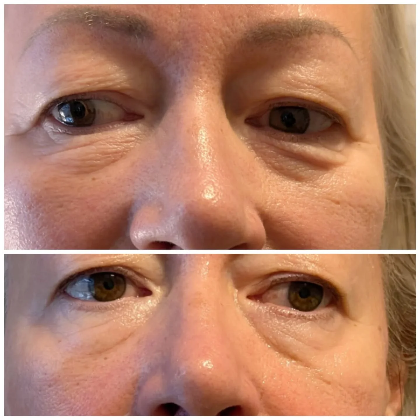 One taster session on my NEW TREATMENT😍

We did the face &amp; neck, but I can't help but share the results on just the eye area alone 😍

✅No downtime 
✅No needles