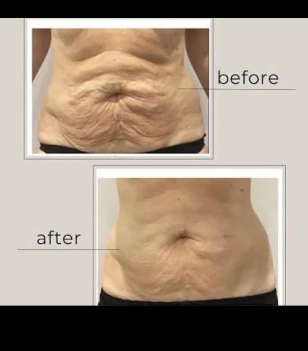 Not only does Hifem Sculpt offer the equivalent to 20,000 sit ups or Squats in just one session!!!! It can also help reduce fat pockets, improve ab separation &amp; to some degree help loose skin caused by quick weight loss 👀🥰