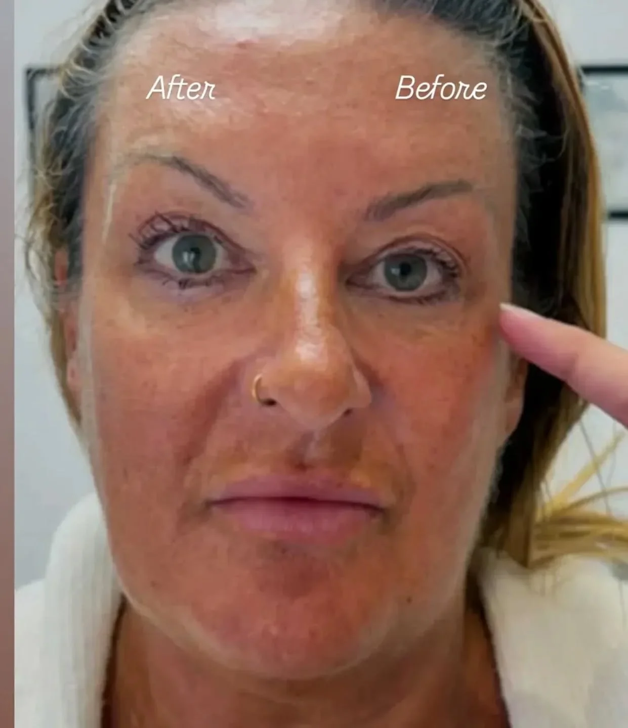 One treatment on one side☝️

✨ Did you know? Facial ageing isn&rsquo;t just about skin &mdash; it&rsquo;s also about muscle loss. Over time, the tiny muscles in our face weaken and shrink, which can cause sagging, hooded eyes and that tired look.

💉