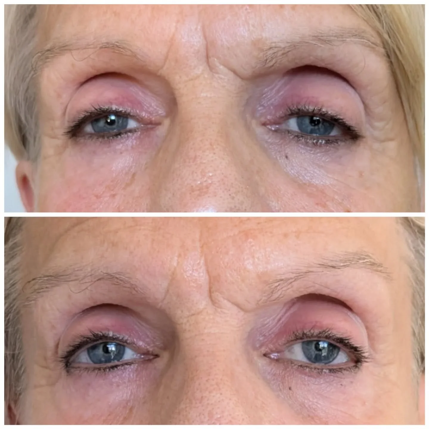 Training is done here's a little peak at just one treatment we did yesterday whilst training on this fantastic new machine 😍

✨ Brand-new eye-lifting treatment available today!

This is just a snippet of what a single session can do &mdash; imagine 