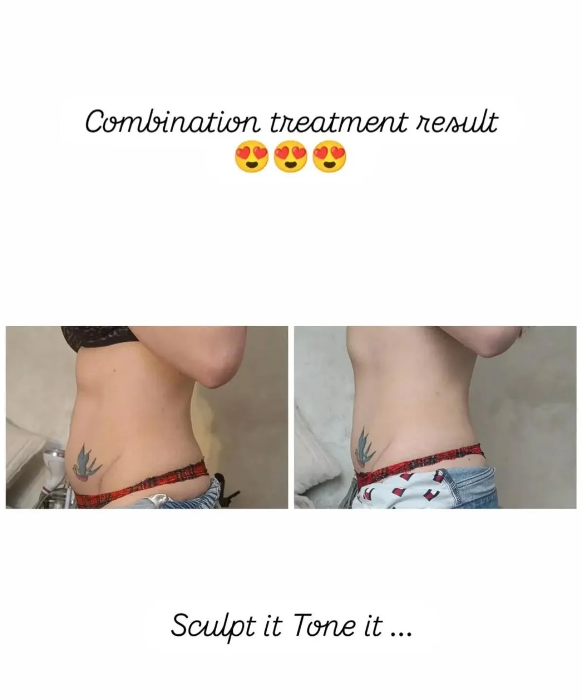 ✨ Ultimate Body Sculpting Combo: Ultrasound Cavitation + HIFEM ✨

Looking to reduce stubborn fat and tone muscle at the same time? Our powerful Ultrasound Cavitation + HIFEM combination delivers next-level body contouring results 💪

🌊 Ultrasound Ca