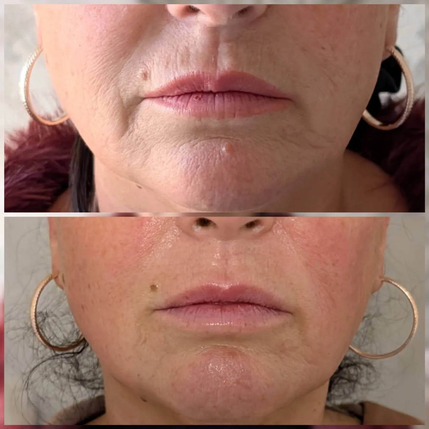 ULTRALIFT ✨

3 Sessions | No Needles | No Downtime

The lift everyone&rsquo;s asking for &mdash; without surgery.
What makes Icon Ultralift a WOW treatment 👇

✨ Visibly lifts &amp; firms sagging skin
✨ Tightens jawline, cheeks &amp; neck
✨ Boosts co