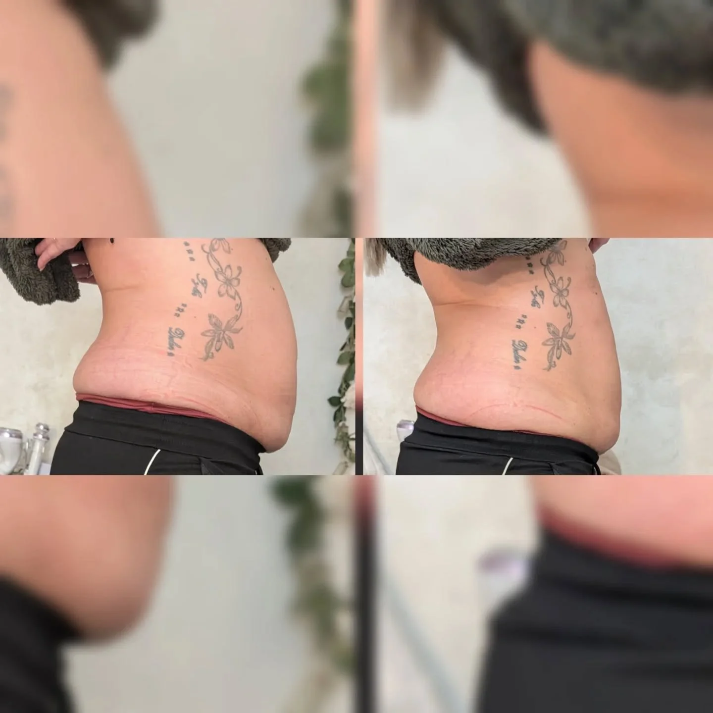 ✨ HANDS ONLY LYMPHATIC TREATMENT ✨

No machines. No gimmicks. Just results.

Feeling bloated? Sluggish? Not quite yourself?

This is your body asking for a reset&hellip;
💆&zwj;♀️ Using specialist manual techniques, this treatment helps:
✔️ Reduce bl