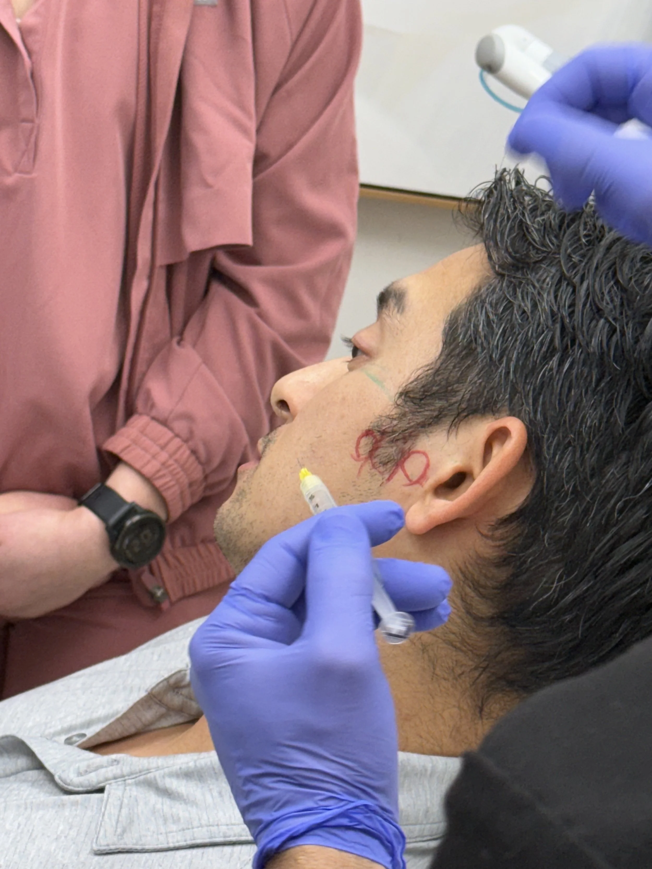 Person receiving a facial injection by a practitioner wearing blue gloves, with red marks on the cheek.