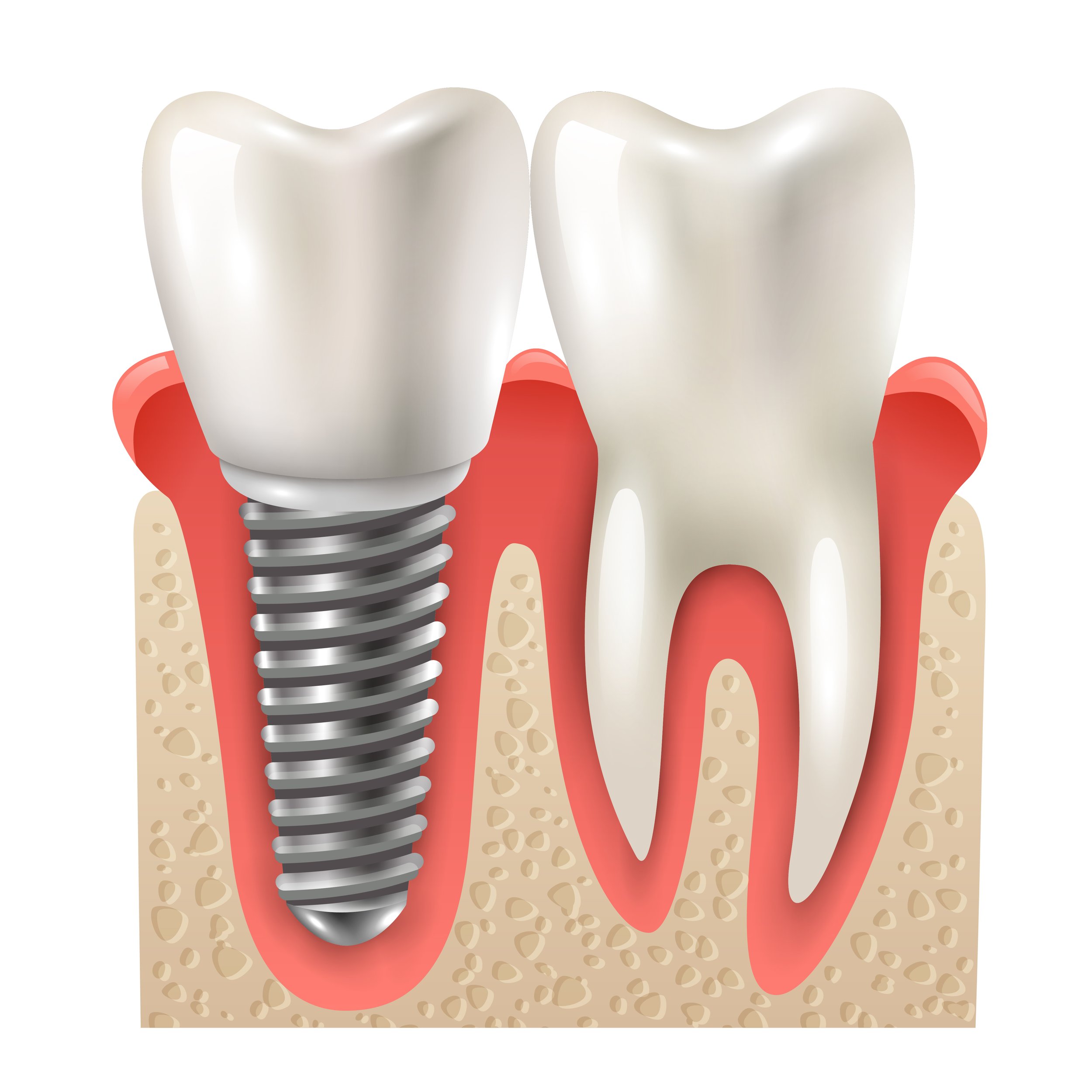 Dental Implants for Dummies