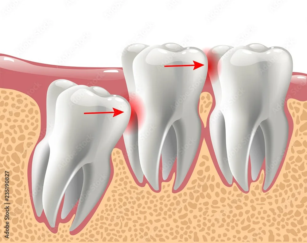 Keeping Wisdom Teeth - Wise or Not?