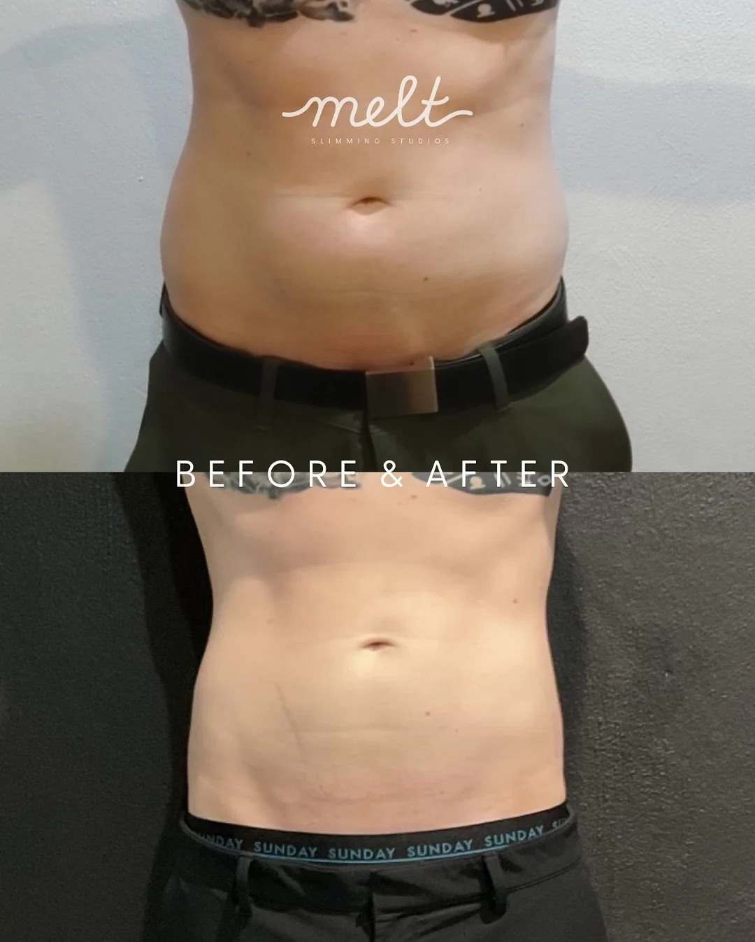 MIDSECTION TRANSFORMATION 😍🫶
Men’s Midsection Melt Package!
Results:
Before & after a course of 3 sessions (spaced 4 weeks apart) targeting the midsection for this handsome client
Package: 
3 x Fat Freezing (Cryolipolysis) Sessions &bul