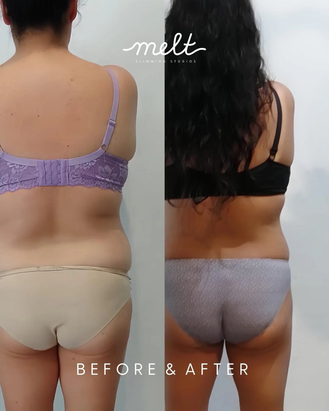 OBSESSED 🥹🫶 
Love Handles • Bra Roll 
Non-surgical fat reduction targeting the midsection (love handles, bra roll) for this beautiful client! 
Before & after only 2 of 3 Cryolipolysis (fat Freezing) sessions 
Want to know more about our