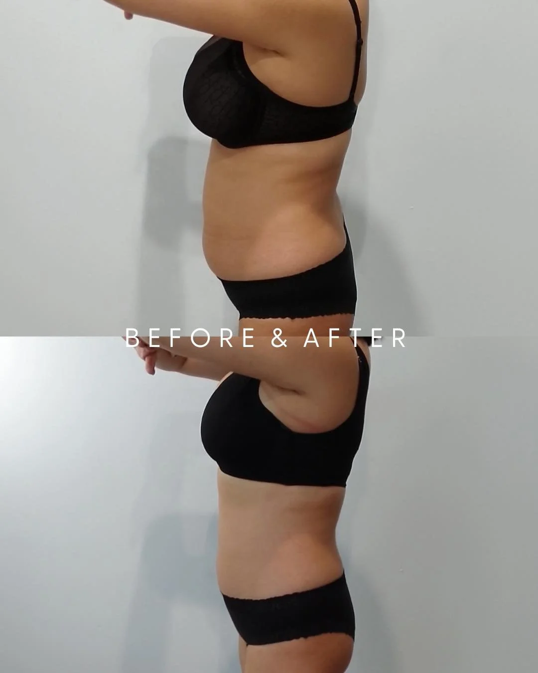 Best-Selling Mummy Makeover Package 😍❤️
Designed to sculpt &amp; transform your waist line without surgery or downtime

Mummy Makeover Package is designed to target:
&bull;Upper &amp; Lower Abdomen
&bull;Bra Roll or Love Handles
4 x Applicators ~ 3 