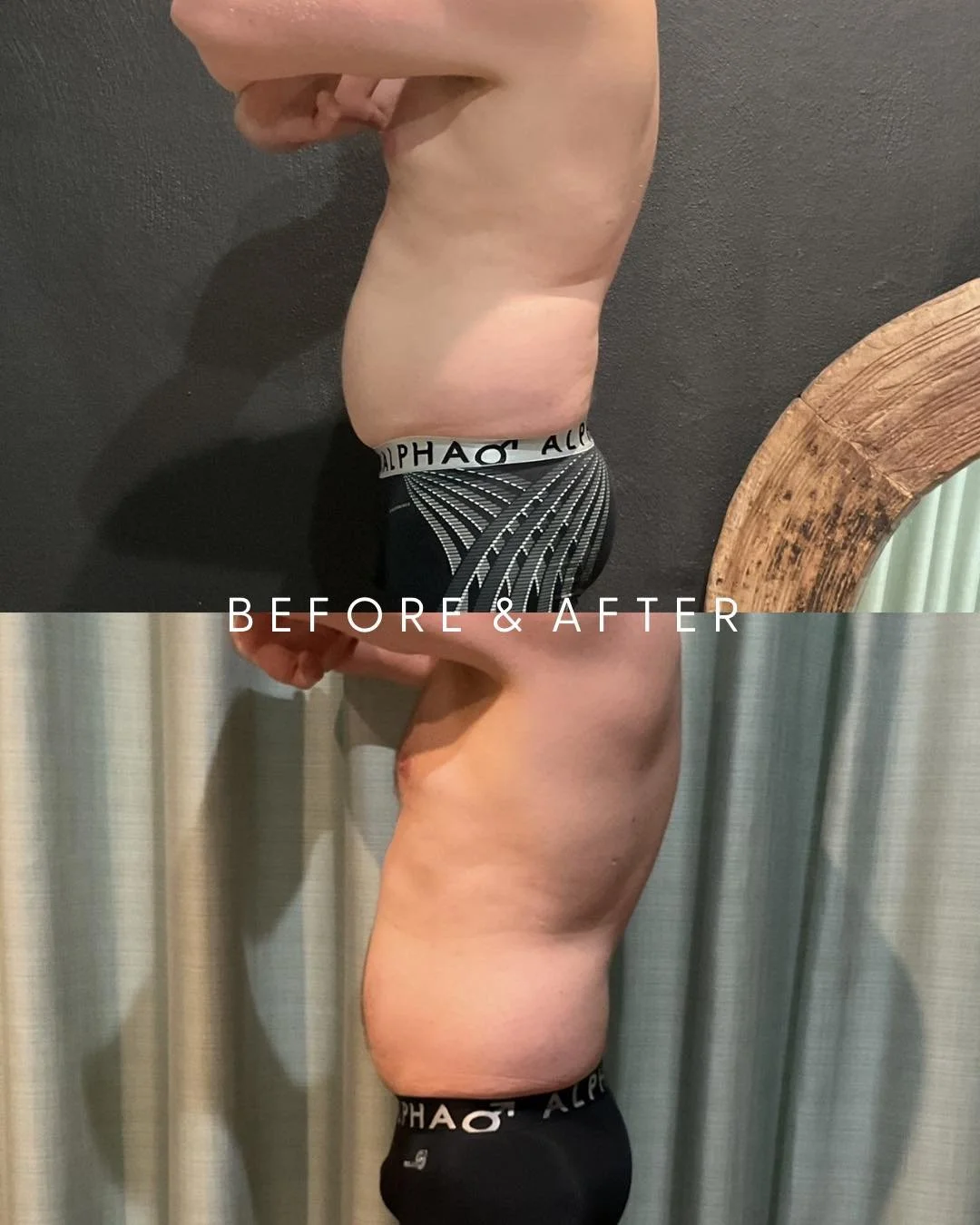 Because Guys Deserve To Look &amp; Feel Their Best Too 😍🫶

RESULTS  Before &amp; After 3 x Sessions of
Non-Surgical Fat Reduction targeting love handles, upper &amp; lower abdomen 

Men&rsquo;s Midsection Melt Package
3 x Fat Freezing (Cryolipolysi