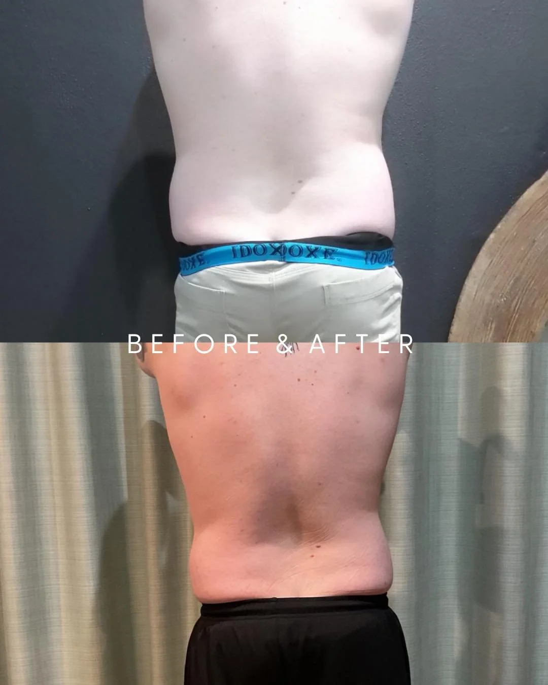 MIDSECTION TRANSFORMATION 😍🫶
Men&rsquo;s Midsection Melt Package!

Results:
Before &amp; after a course of 3 sessions (spaced 4 weeks apart) targeting the midsection for this handsome client

Package: 
3 x Fat Freezing (Cryolipolysis) Sessions &bul