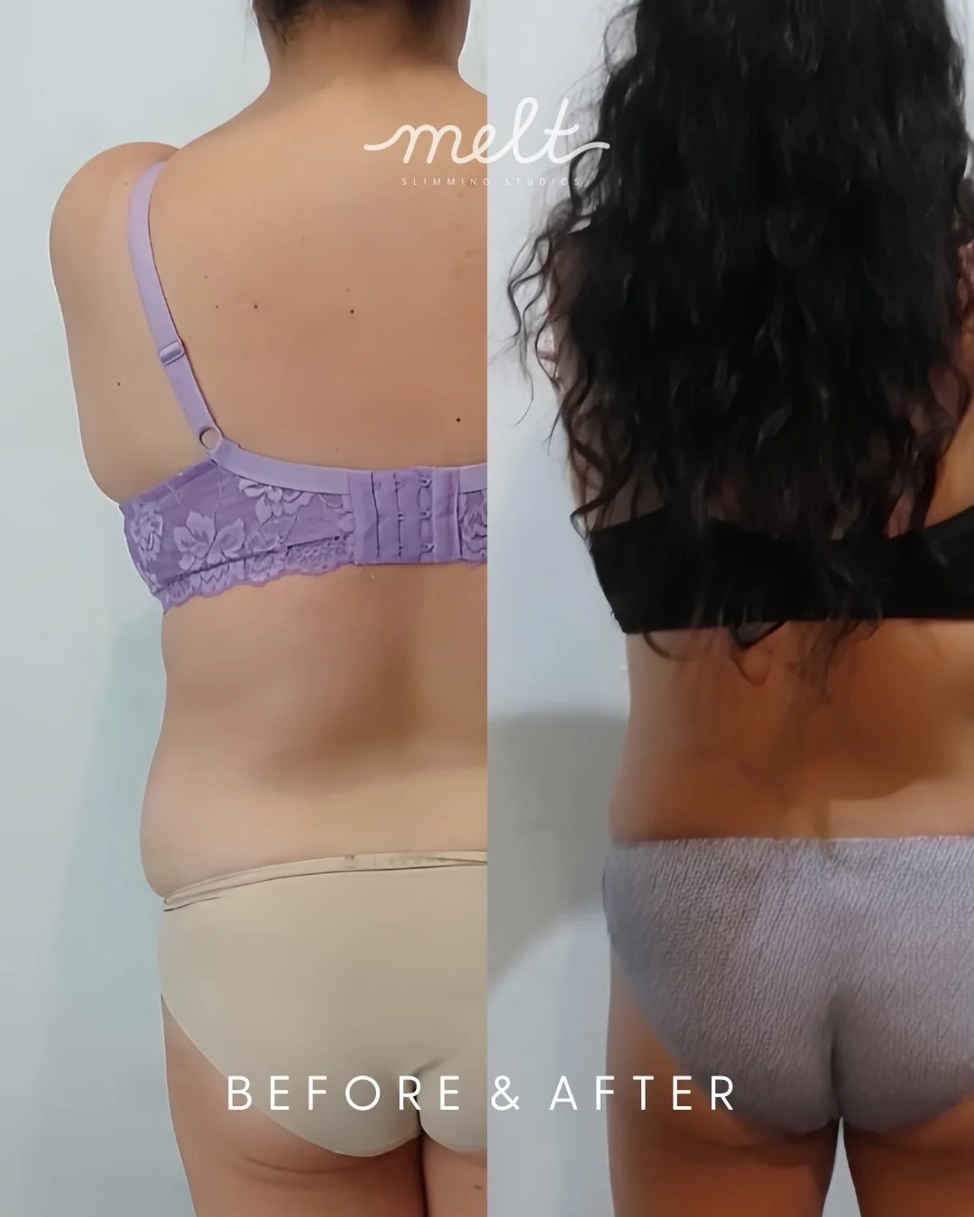 MUMMY MAKEOVER &bull; LOVE HANDLES &amp; BRA ROLL 

Results speak for themselves 😍🥹

Before &amp; after a course of 3 sessions (spaced 4 weeks apart) targeting the midsection - &lsquo;love handles&rsquo; &amp; &lsquo;bra roll&rsquo;

Mummy Makeover