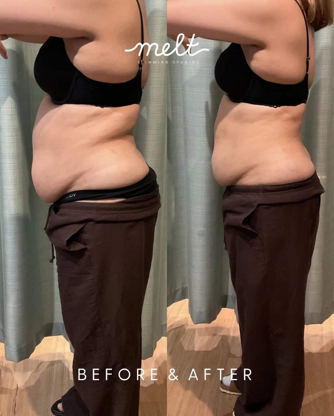 B e f o r e &amp;  A f t e r 
MUMMY MAKEOVER PACKAGE &bull; Waist, Upper &amp; Lower Abdomen 
What a result for this lovely client 😍🫶 

Before &amp; after a course of 3 sessions (spaced 4 weeks apart) targeting the midsection - tummy (upper &amp; l