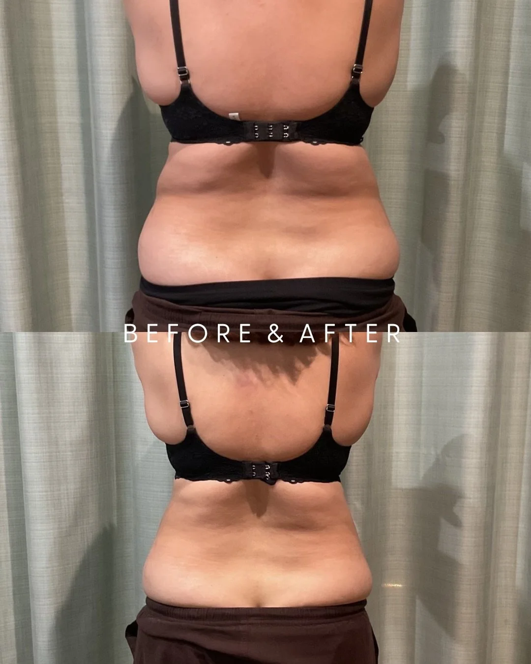 B e f o r e &amp;  A f t e r  R e s u l t s 😍
Transforming the tummy &amp; waist line 

Our Mummy Makeover Package 
4 x Applicators &bull; 3 x Fat Freezing Treatments 
NOW $999 (was $2079) 

Targeting the midsection - tummy (upper &amp; lower) and w