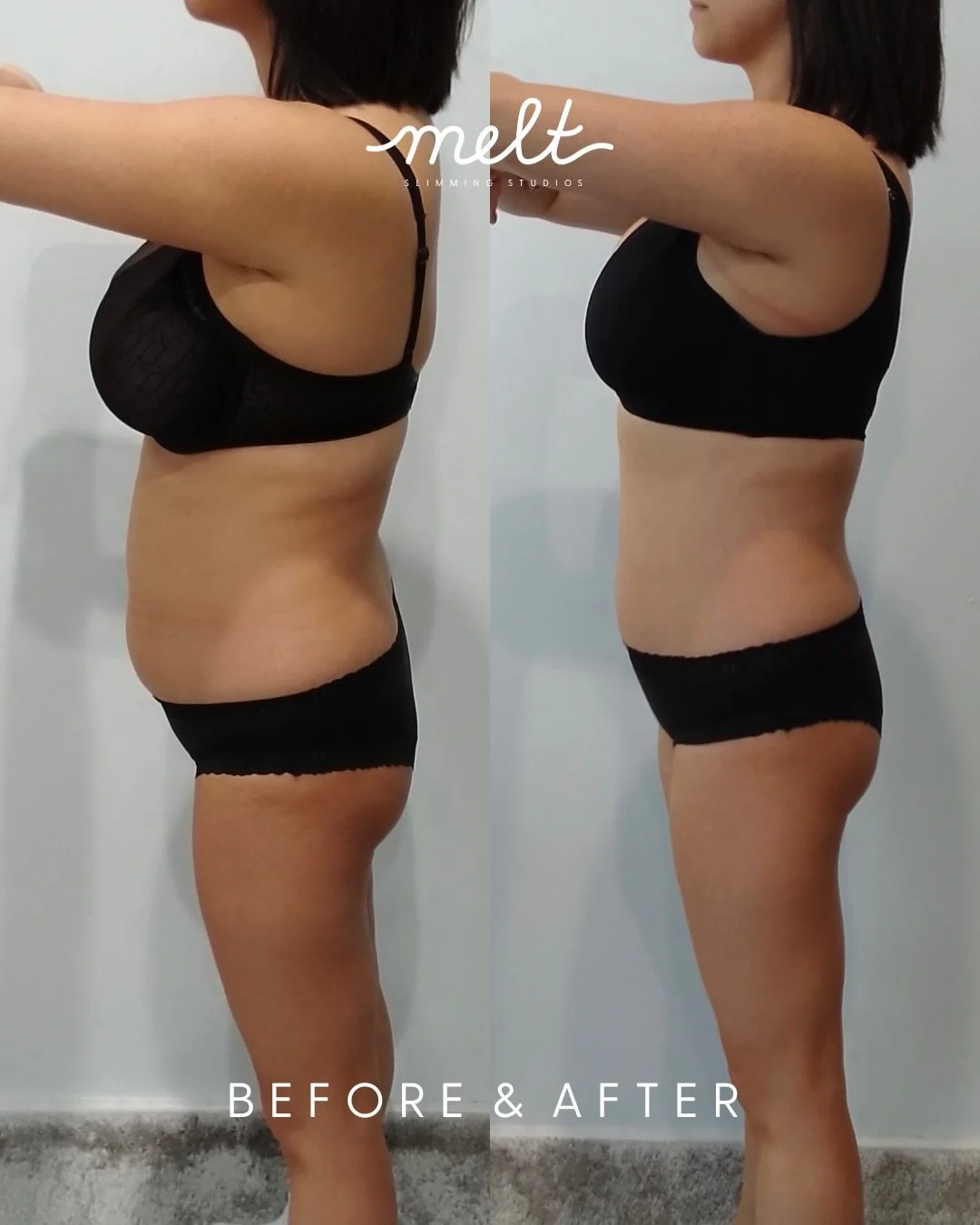 She came in feeling stuck. She left feeling like herself again. 🤍

This is a real Melt client &mdash; 3 sessions of Cryolipolysis targeting her upper and lower
abdomen and waist. No surgery. No downtime. Just consistent, science-backed fat freezing 