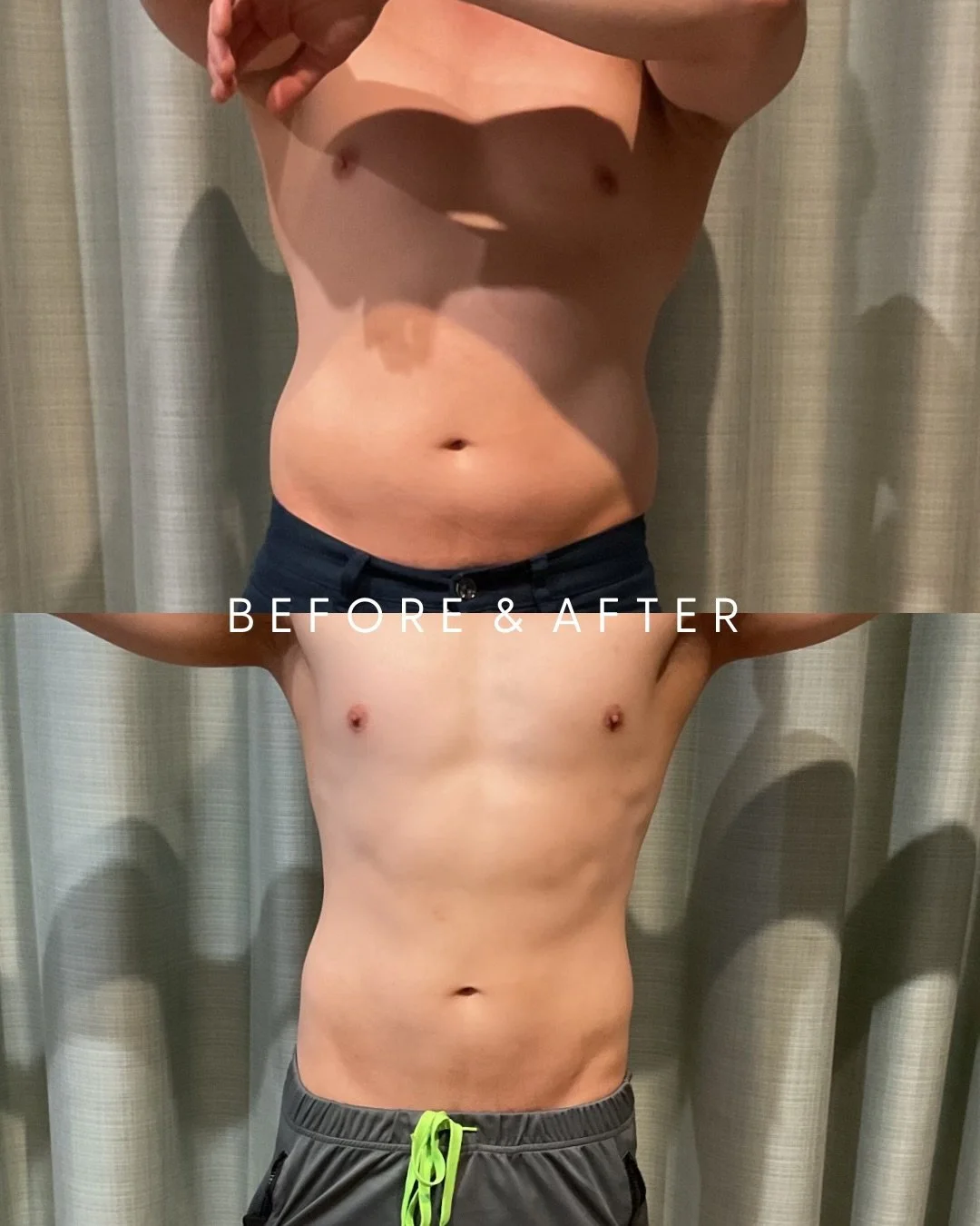 Fat freezing isn&rsquo;t just for women. 💪

Meet one of our male clients &mdash; targeting the midsection with our Men&rsquo;s Midsection
Package! 
3 sessions. 4 applicators. Real results.

Men store stubborn fat differently &mdash; and Cryolipolysi