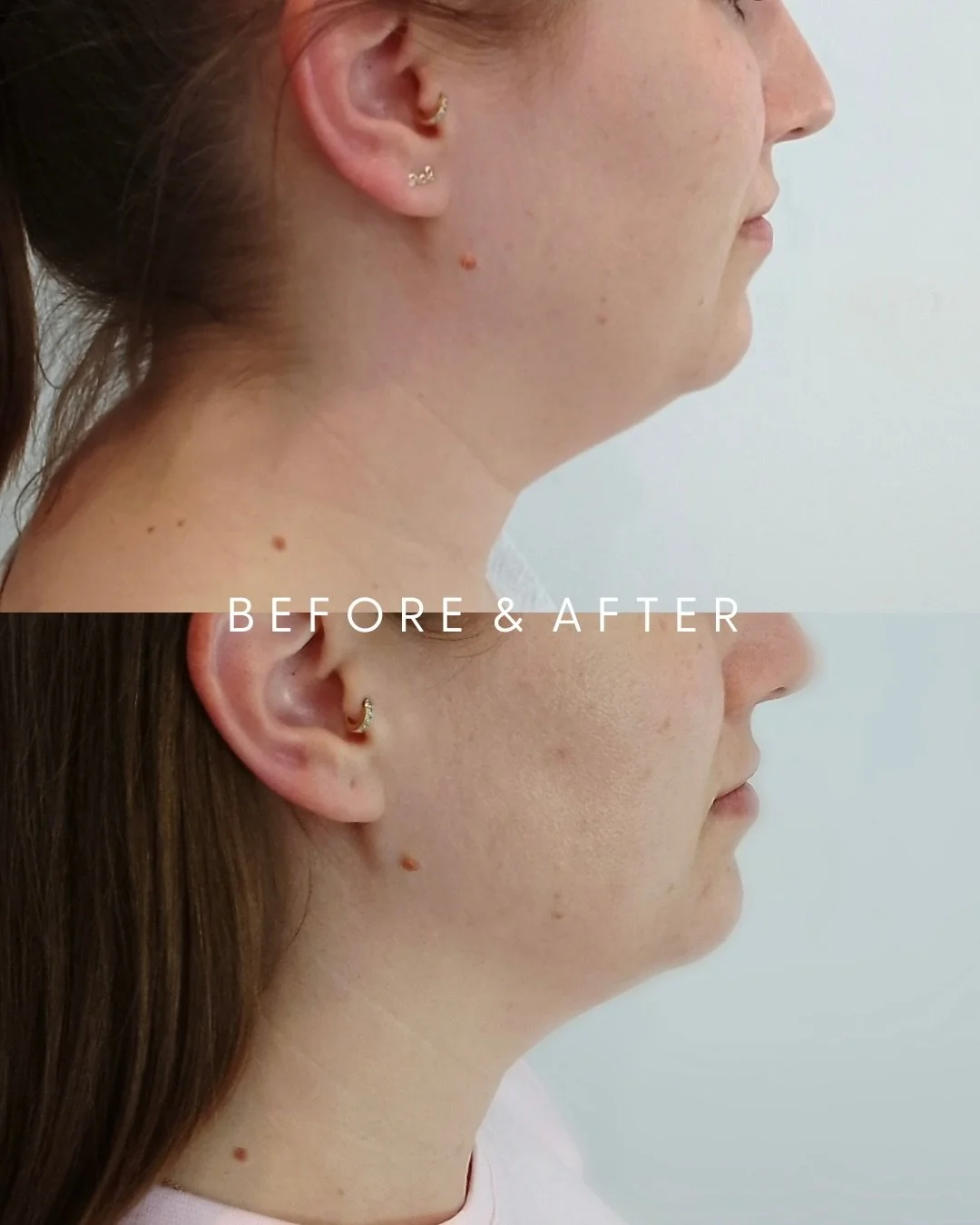 Say Goodbye to Stubborn Chin Fat 😍 Double Chin Reduction Special
Non-Invasive &bull; Highly-Effective &bull; No Downtime

NOW $149 (was $279) &bull; Package of 3 NOW $447 (was $747) 

Non-surgical Fat Freezing treatments permanently removes up to 40