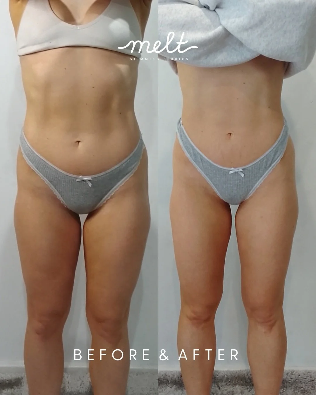 3 sessions. 4 applicators. One incredible result. ✨

This client targeted her thighs &mdash; upper &amp; inner with our Custom Non-Surgical BBL Cryolipolysis Package.

Treatments were spaced 4 weeks apart. Results shown at the 3-month mark as the bod