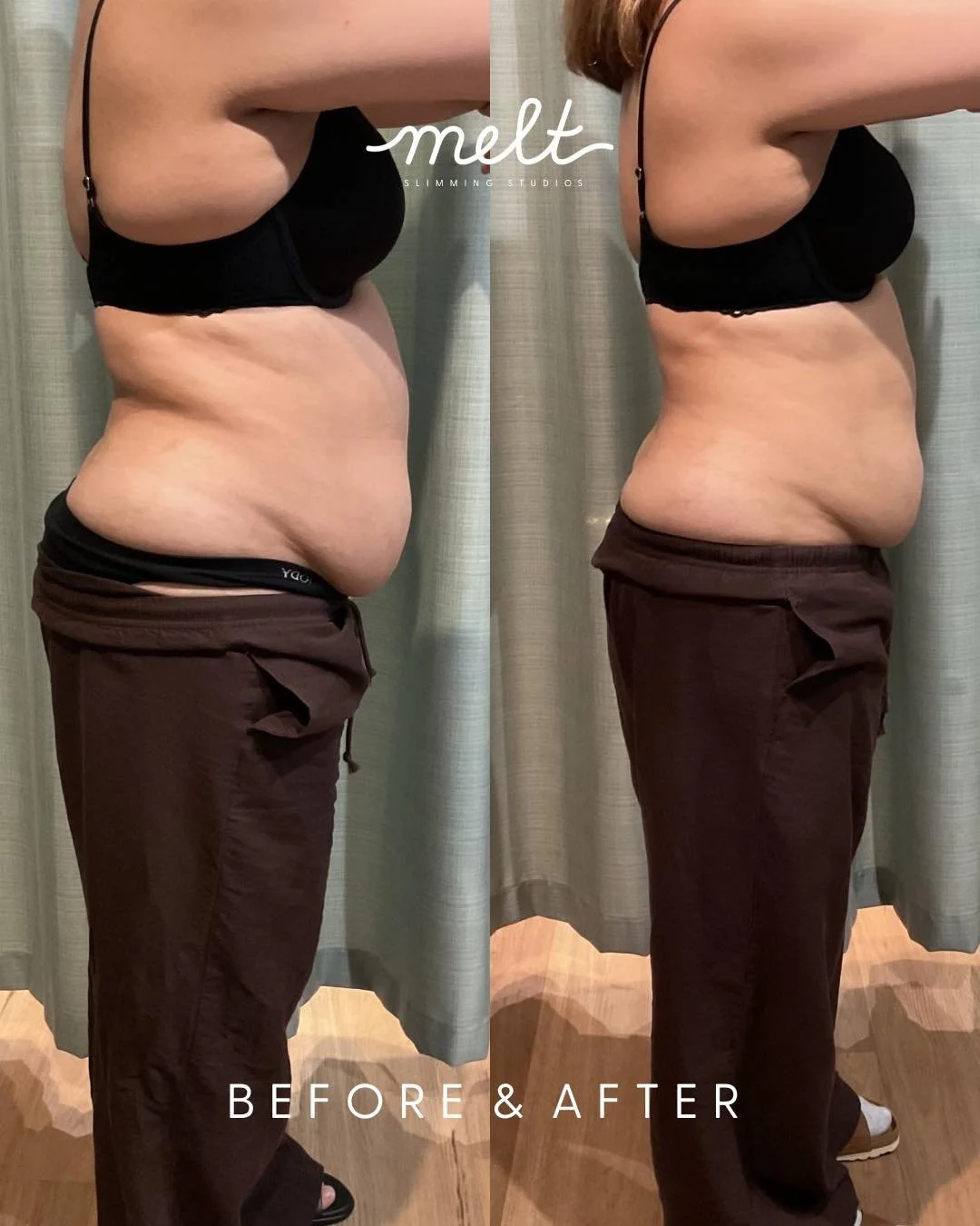 REAL CLIENTS. REAL RESULTS 😍 
This is what consistency &amp; the right treatment looks like! 

ALL BEFORE &amp; AFTER 3 sessions of non-surgical targeted fat reduction at Melt

Cryolipolisis aka Fat Freezing &mdash; for optimum results we recommend 