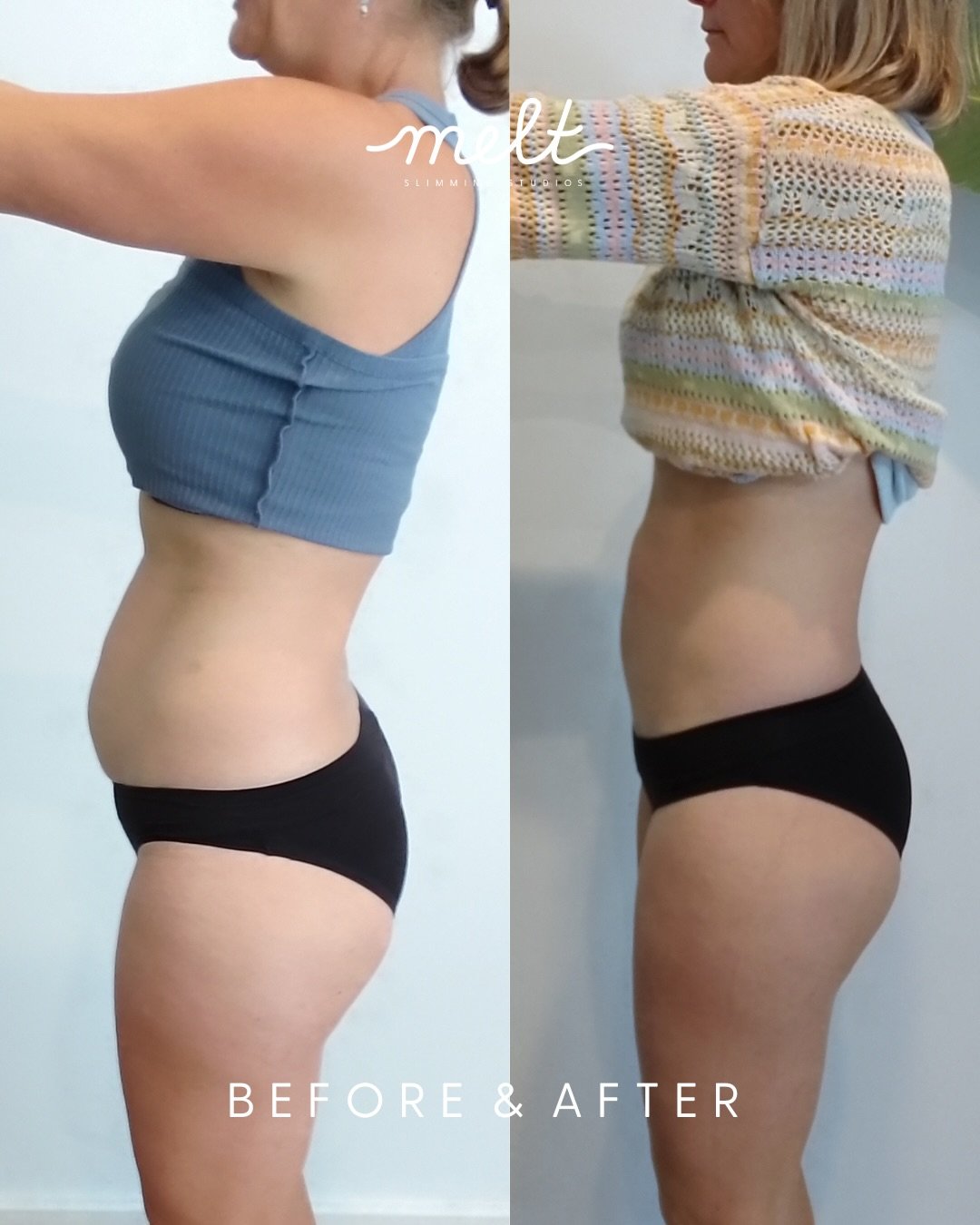 Before &amp; After 😍🥹 Non-Surgical Mummy Makeover 
3 Sessions. 4 Applicators. 1 Incredible Transformation.

This is a real Melt client &mdash; results after targeting her upper and lower abdomen and waist. 
No surgery. No downtime. Just consistent,