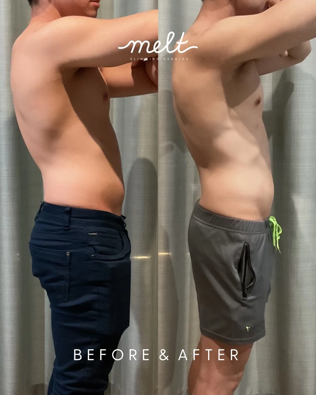 Supercharge Your Weight-Loss Goals in Just
8 Weeks! Non-Invasive Fat Reduction Treatments &mdash; Your Sculpt-Body Cheat Code ❤️&zwj;🔥

BEFORE &amp; AFTER RESULTS 
A real Melt Client after 3 x sessions of 4 x applicators targeting his midsection! 

