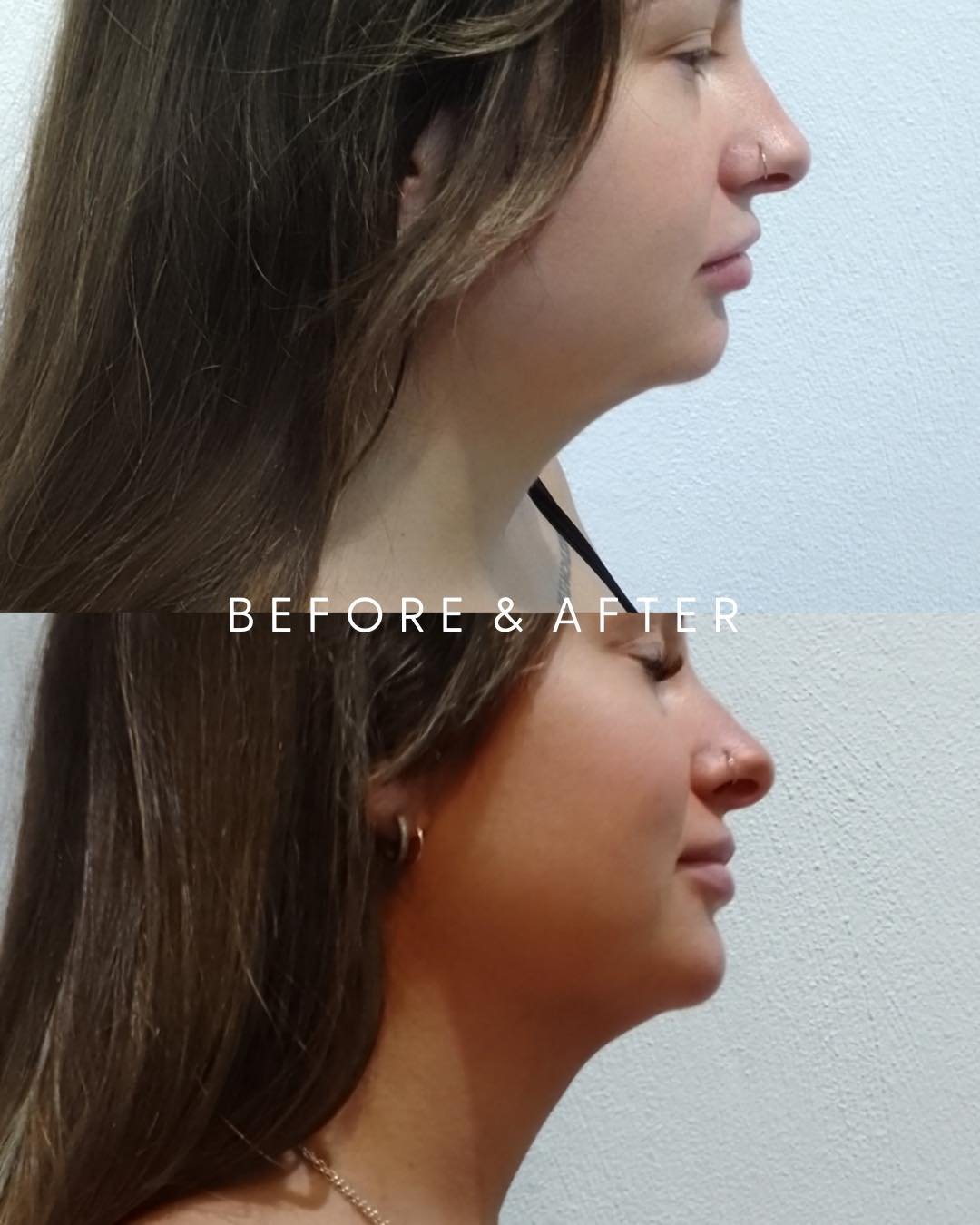 What happens when you follow the treatment plan 😍 Non-Surgical Chin Reduction

These are REAL Melt clients &mdash; results Before &amp; After 3 X Cryolipolysis Treatments 
spaced 4 weeks apart. Targeting double chin fat and sculpting the jawline

Do