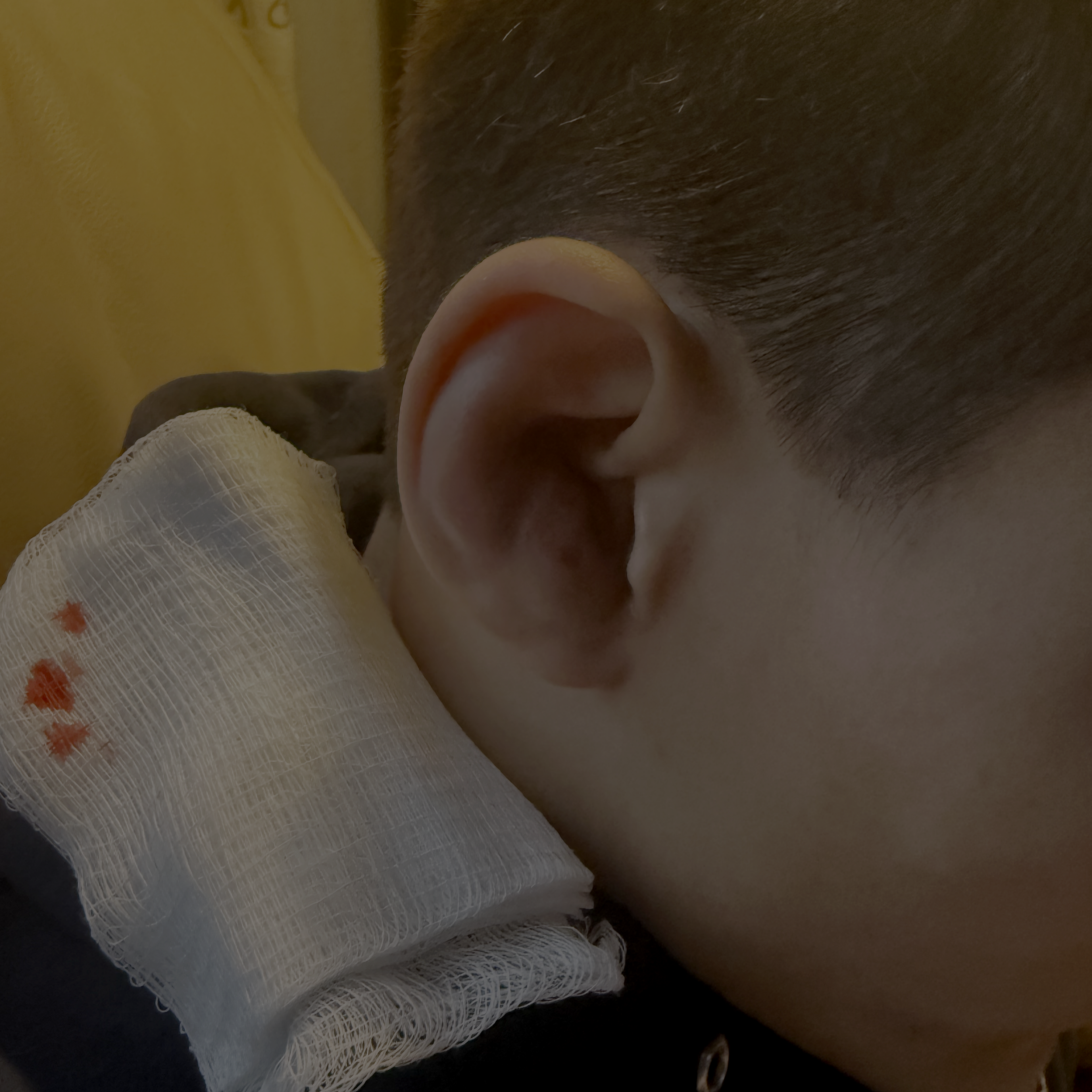 Cauliflower Ear in Wrestling: What Every Parent and Coach Needs to Know