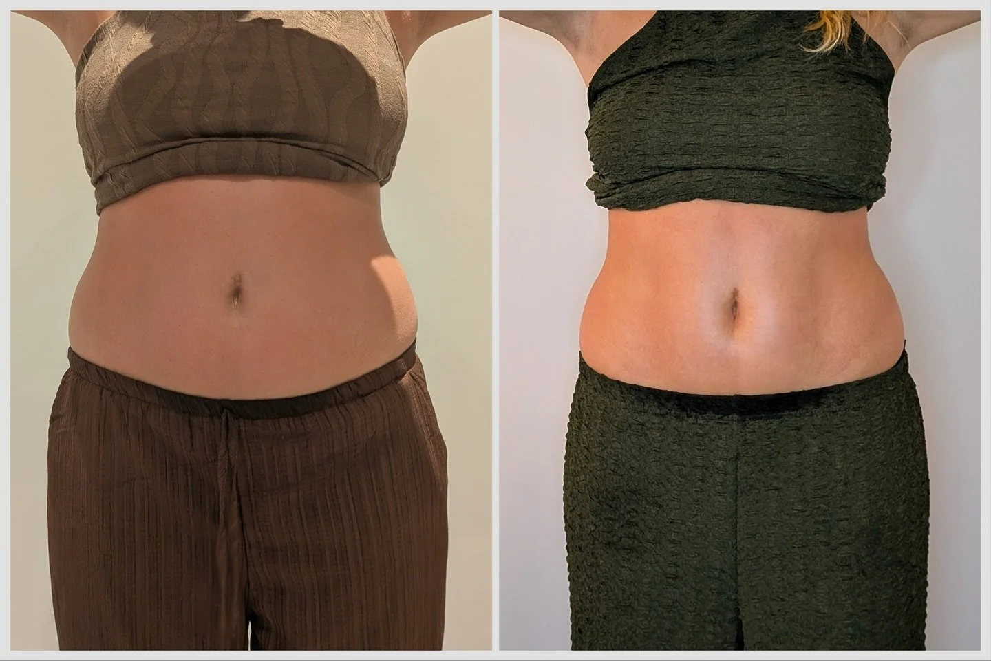 Before &rarr; After (5 TANIT BODYSCULPT sessions) ✨

Notice the difference in the abdomen &mdash; smoother, tighter, and more defined, with visible reduction in volume.

With summer right around the corner, now is the perfect time to start working to
