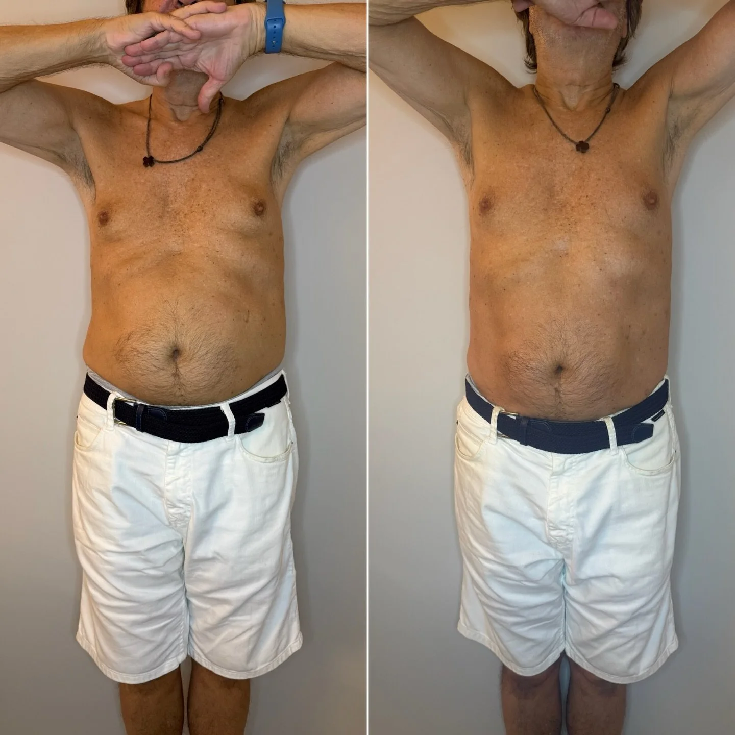 Before &rarr; After with TANIT ✨
Results after just one session.

TANIT is a non-invasive hybrid body treatment that combines three advanced technologies to regenerate tissue, reduce localized fat, and improve skin quality &mdash; all with no downtim