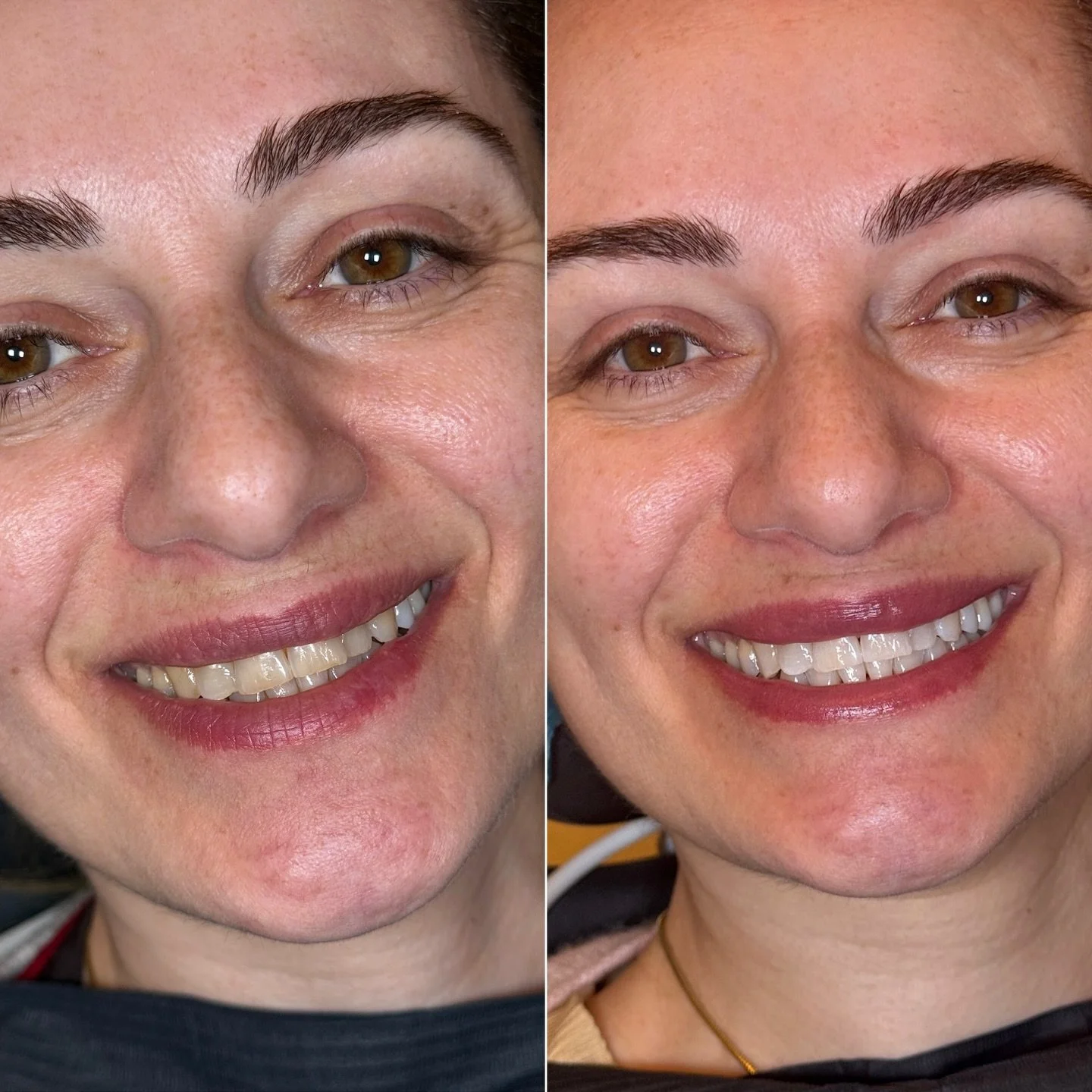 Your smile, taken care of. Professional whitening in clinic, followed by your own at-home kit to maintain the results.
🤍 Book now at the link in bio.

Tu sonrisa, bien cuidada. Blanqueamiento profesional en cl&iacute;nica, seguido de tu kit en casa 