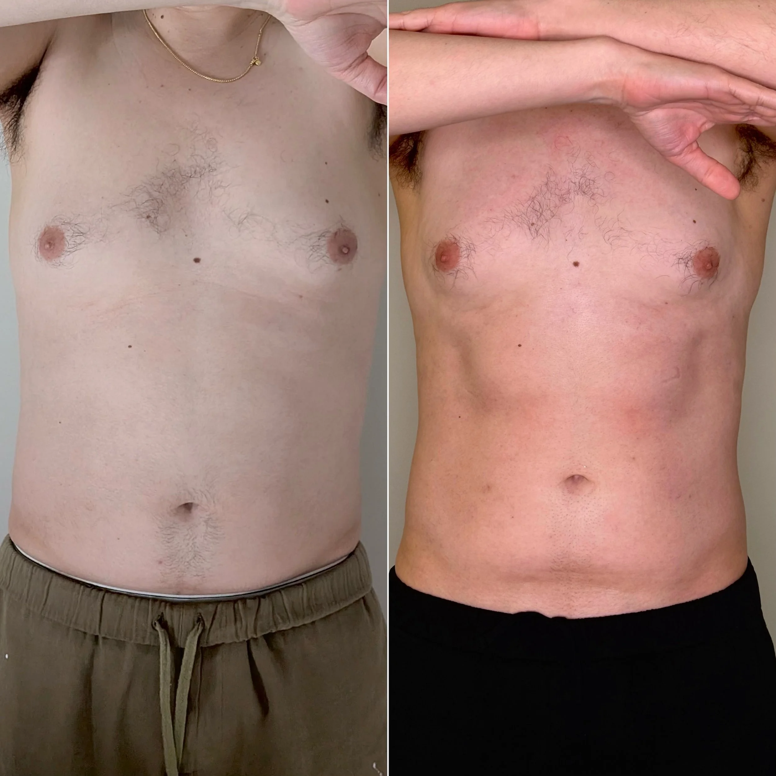 Before &amp; after results ✨
Achieved with consistent sessions using INDIBA and TANIT body sculpting at COSMOGLOW. #INDIBA #TANIT #beforeandafter