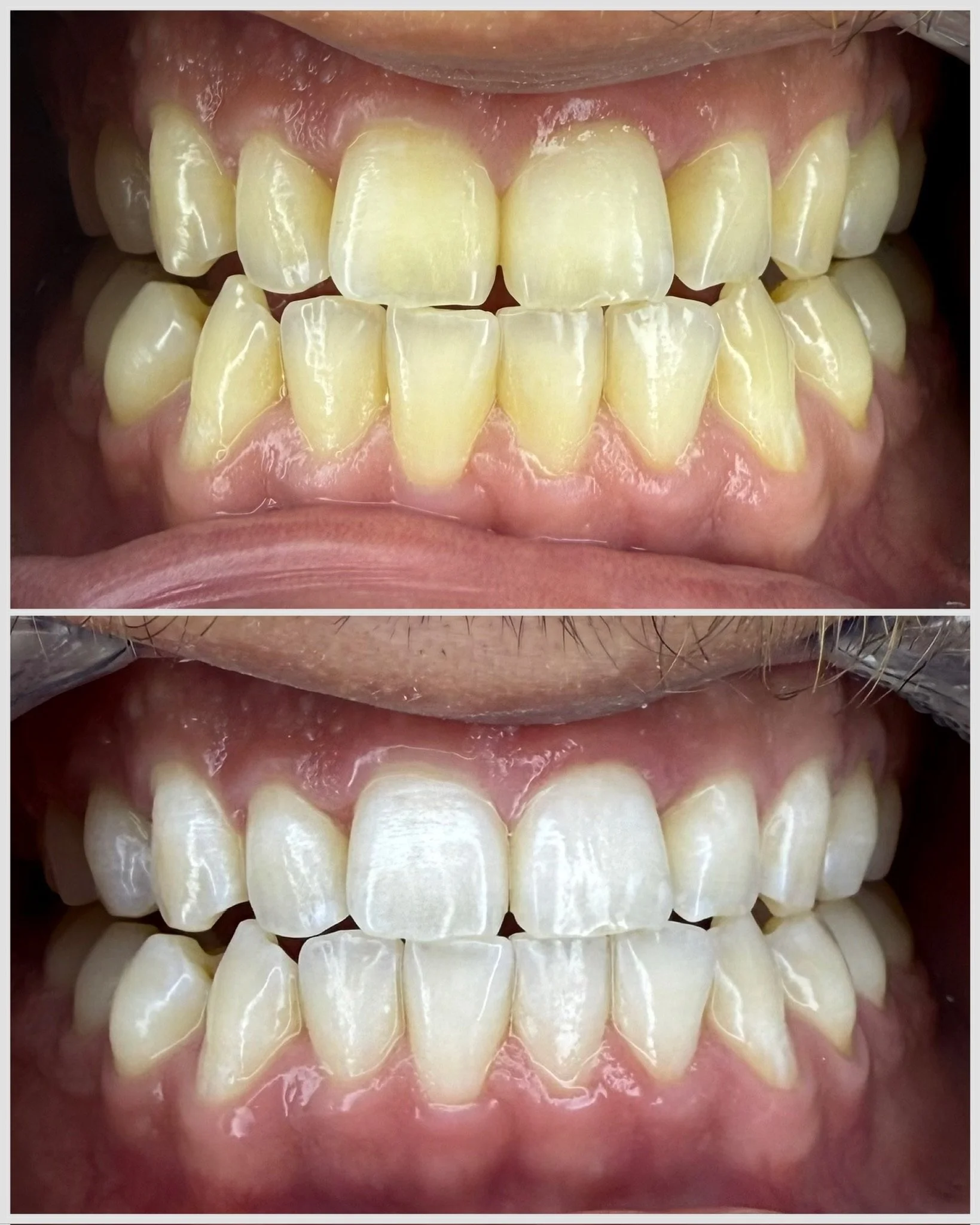 Comparison of teeth before and after dental cleaning, showing cleaner and whiter teeth in the second image.