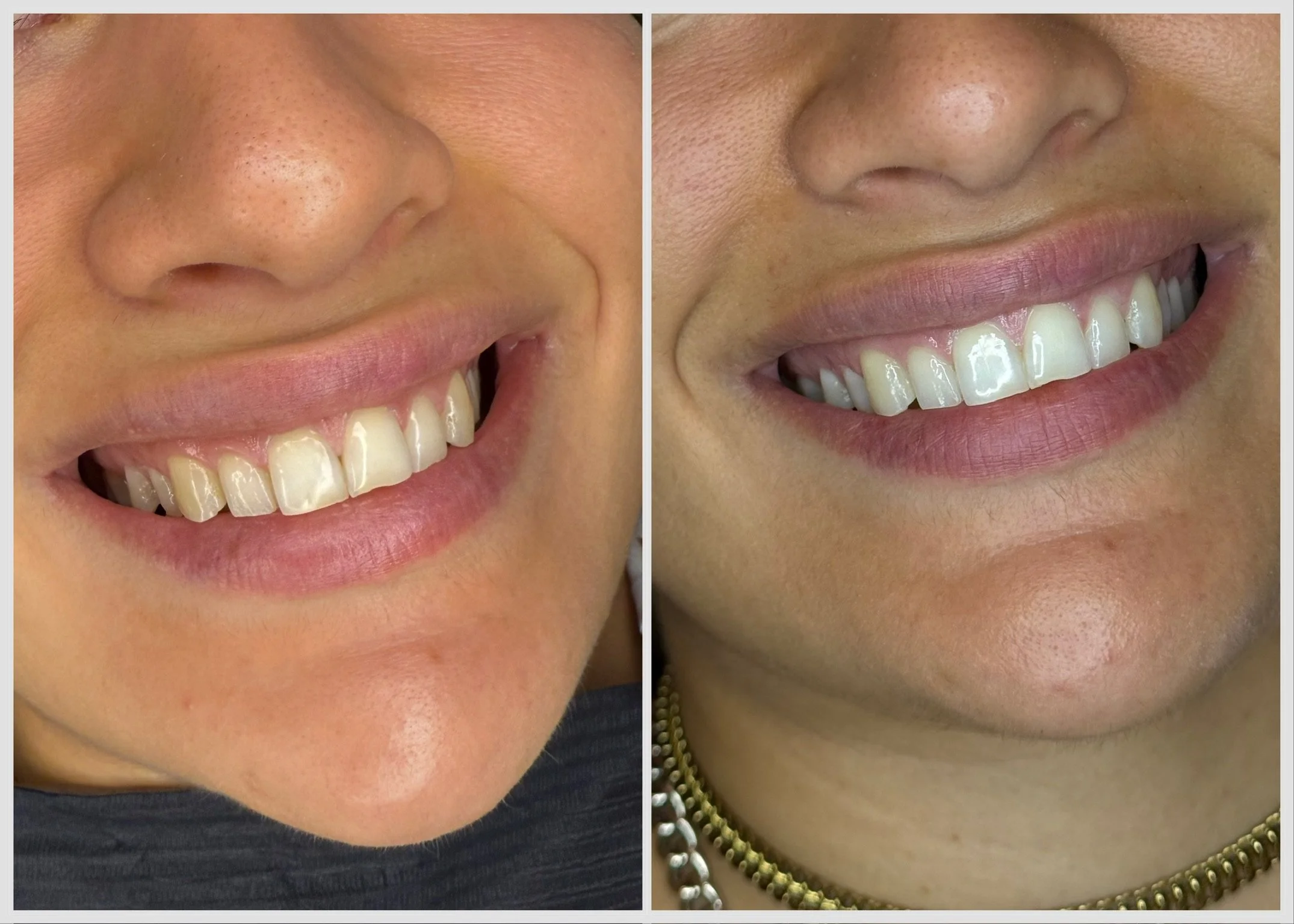 Side-by-side close-up images of a person's smile showing their teeth before and after dental treatment. The left image displays teeth with visible chipping and discoloration, while the right image shows teeth that are cleaner, whiter, and more evenly shaped.